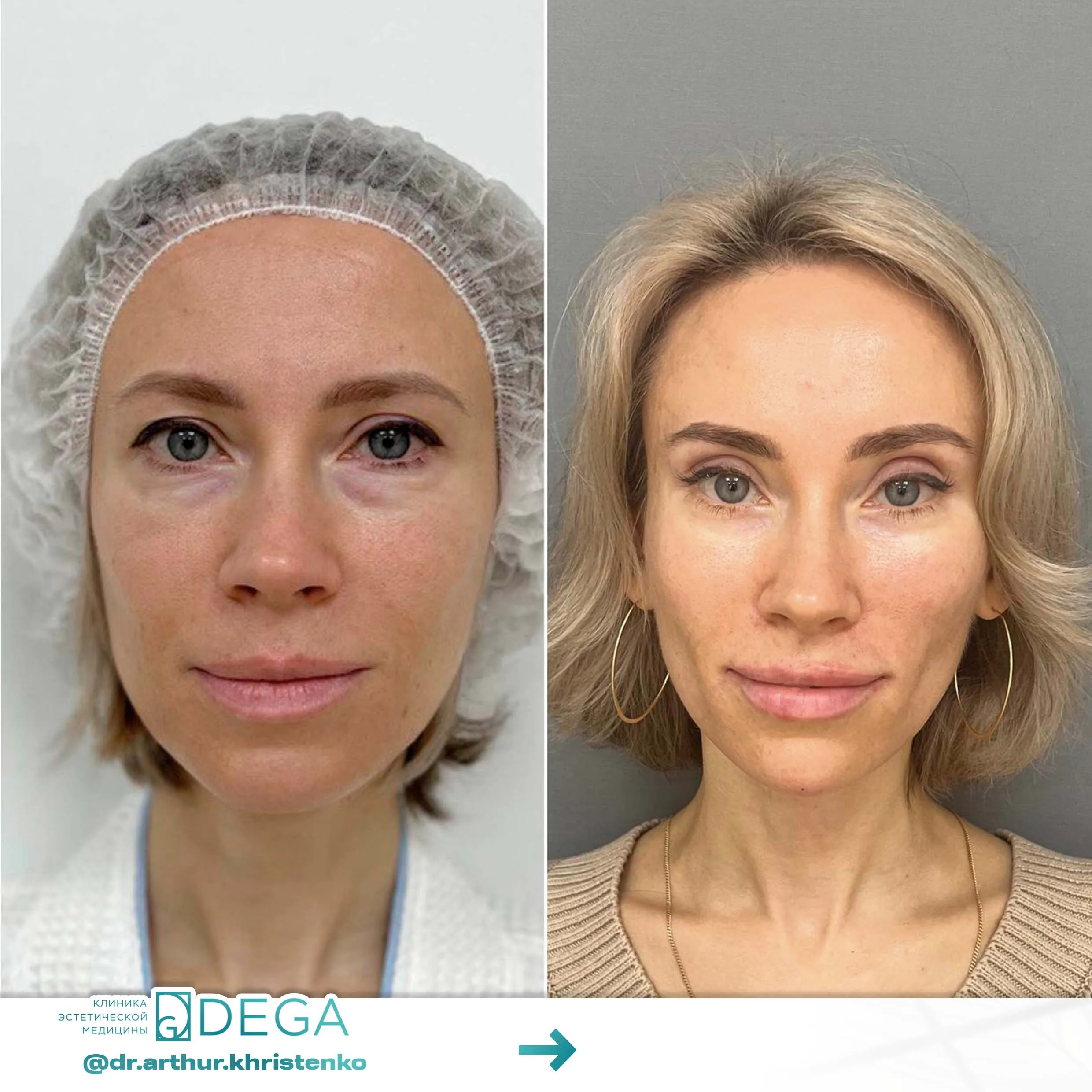 Христенко АА - Эндоскопическая подтяжка№35