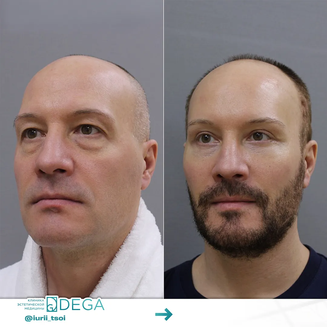 Цой ЮР - Блефаропластика №24