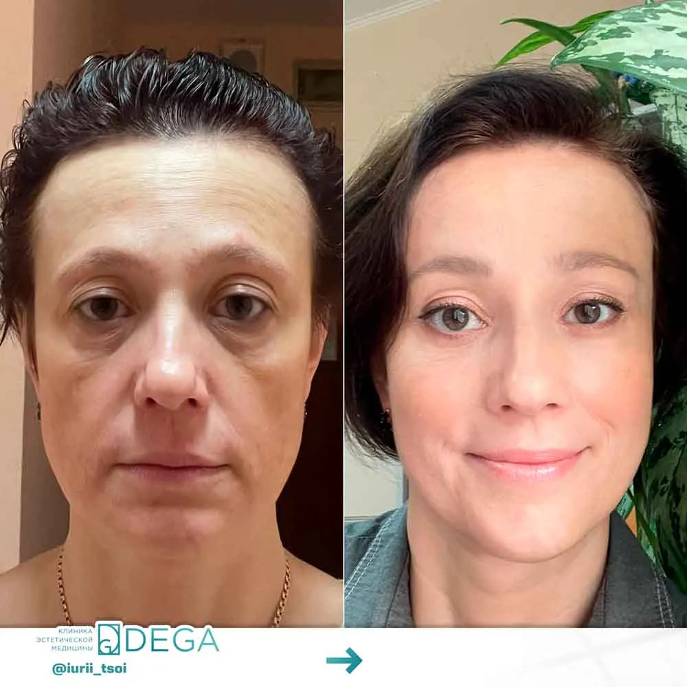 Цой ЮР - Эндоскопическая периорбитопластика, Блефаропластика №2