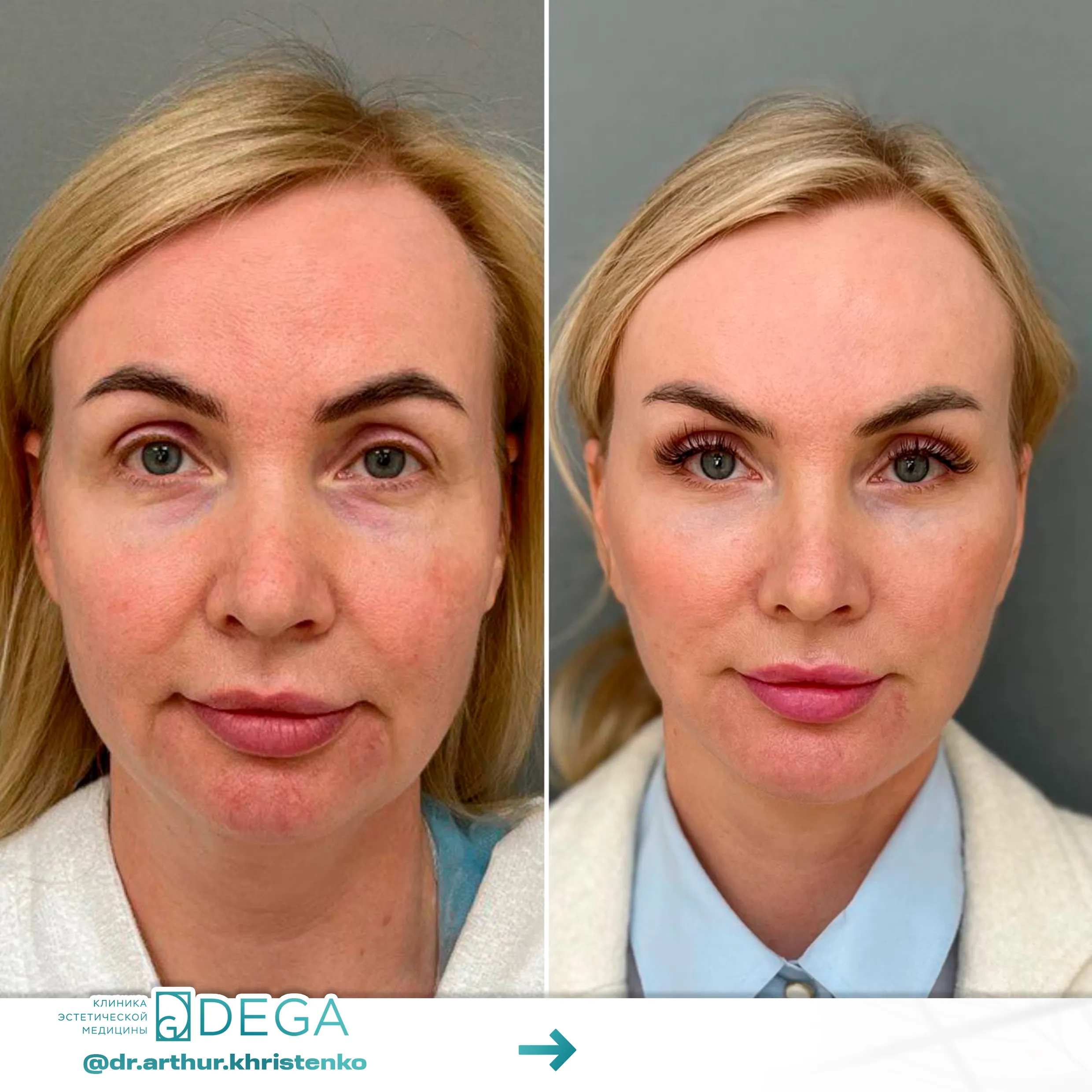 Христенко АА - ESP-Lifting, Эндоскопическая подтяжка, Фейслифтинг, Платизмопластика №20