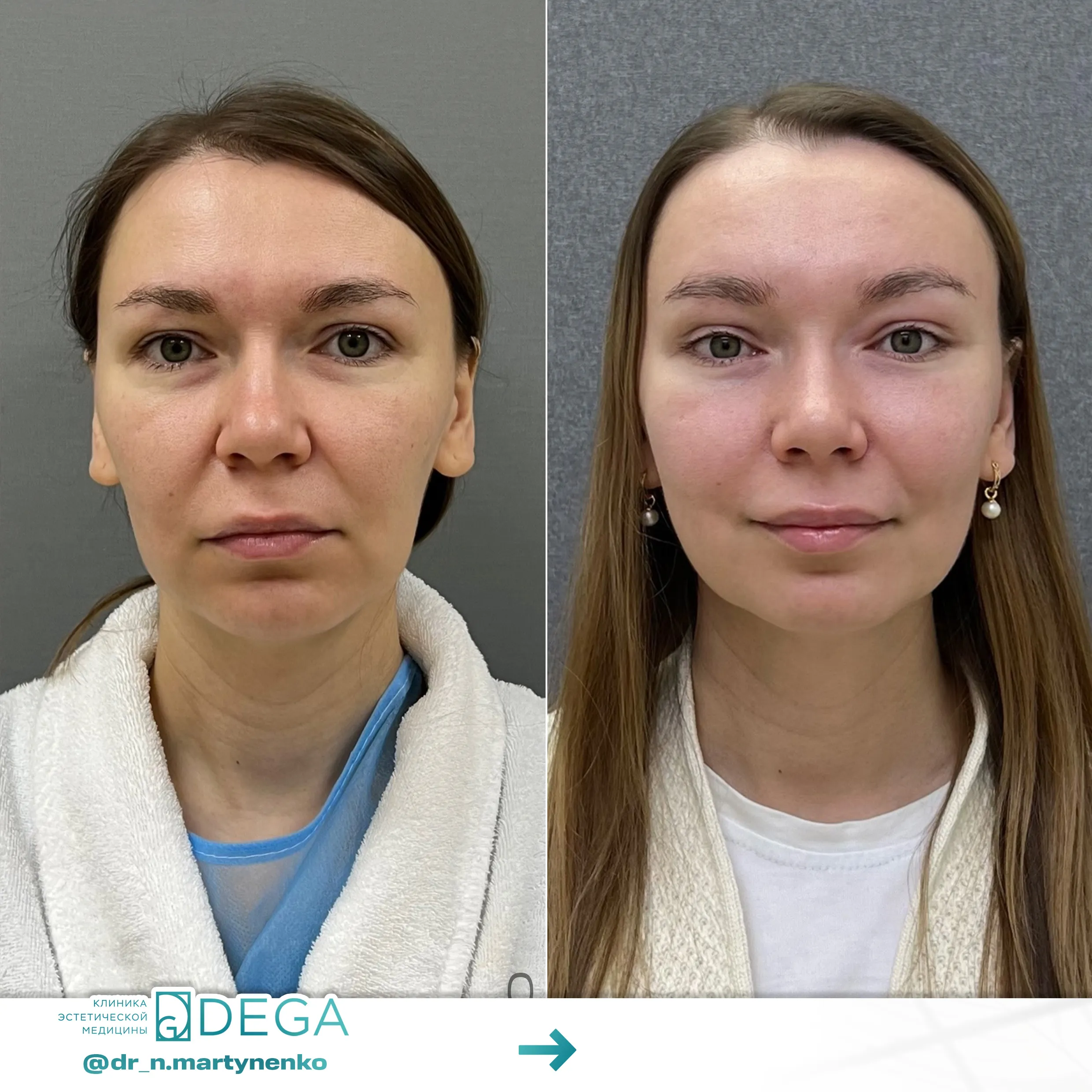 Мартыненко Н. А. — Эндоскопическая подтяжка лица №12