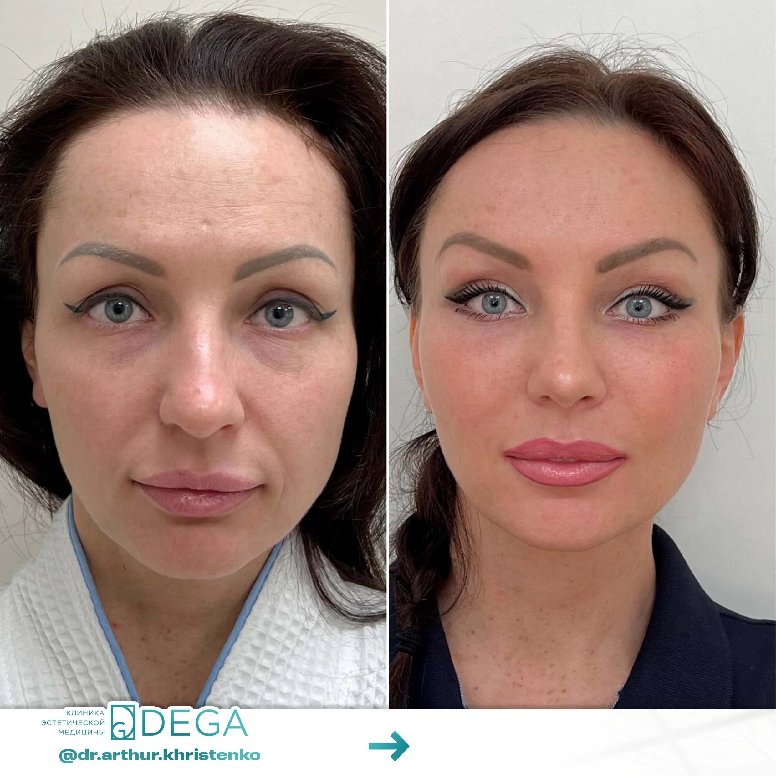 Христенко АА+ Гаврильченко АА - Эндоскопическая подтяжка, Блефаропластика, Комки Биша №30