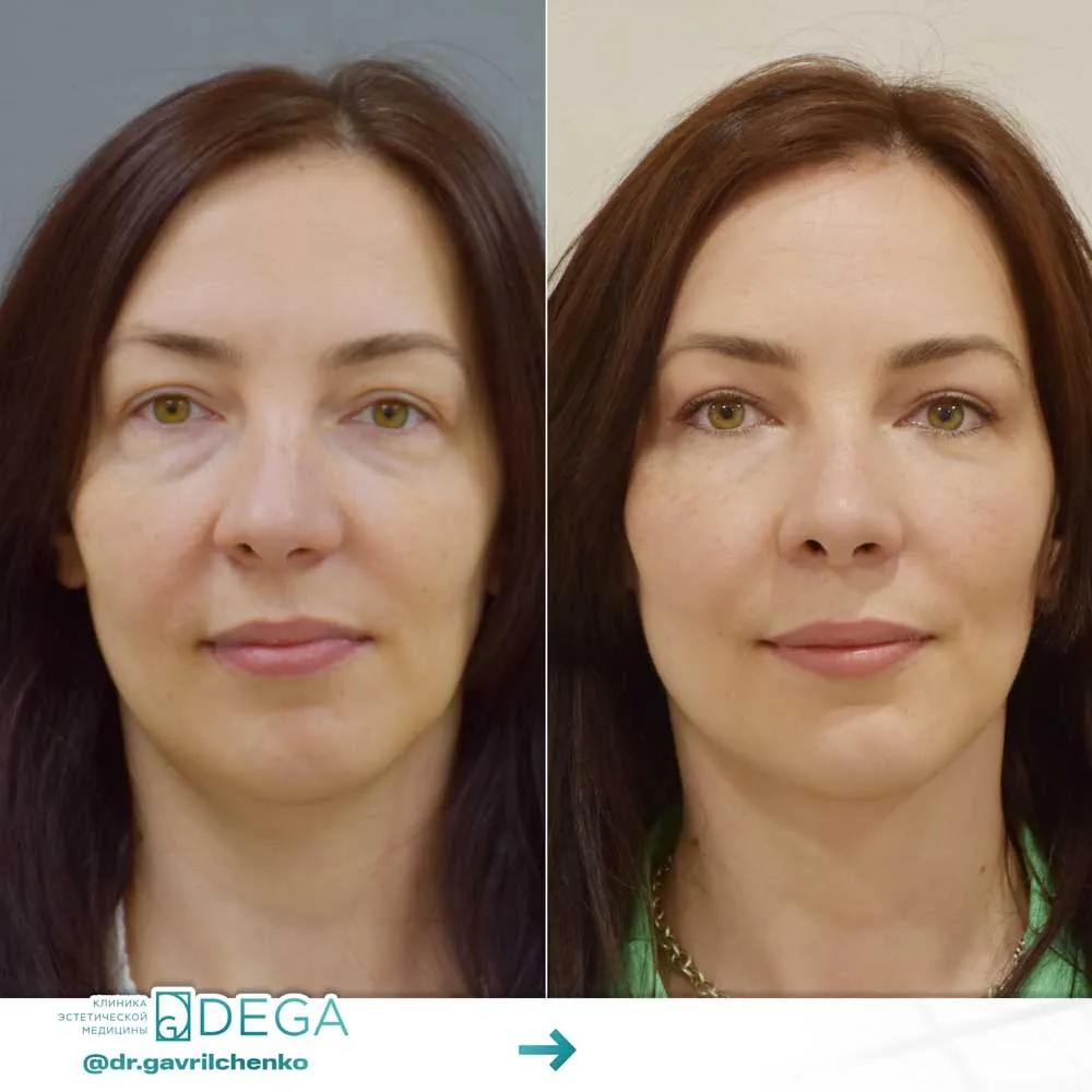 Гаврильченко АА - Ринопластика, Блефаропластика №13