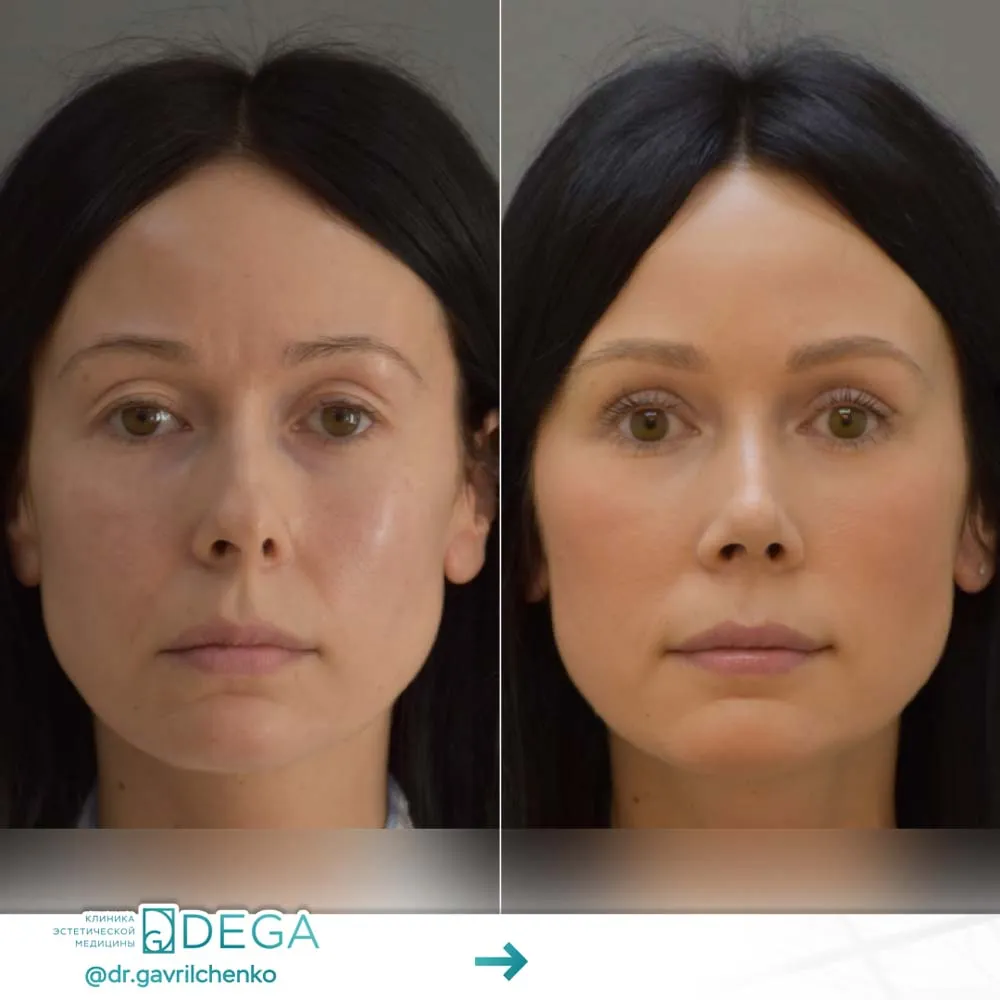 Гаврильченко АА - Ринопластика, Блефаропластика №3