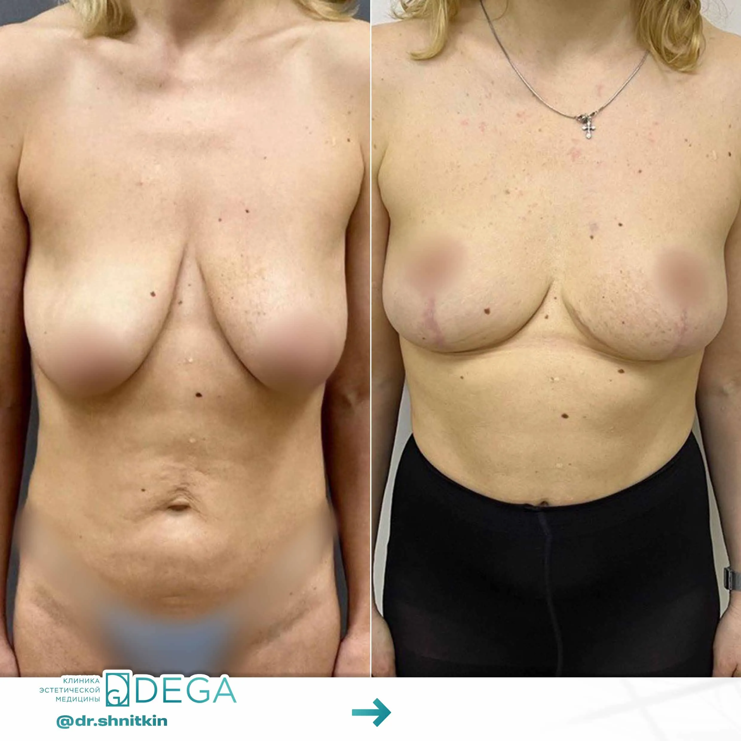 Шниткин Антон Сергеевич №9 Маммопластика Мастопексия (подтяжка груди)