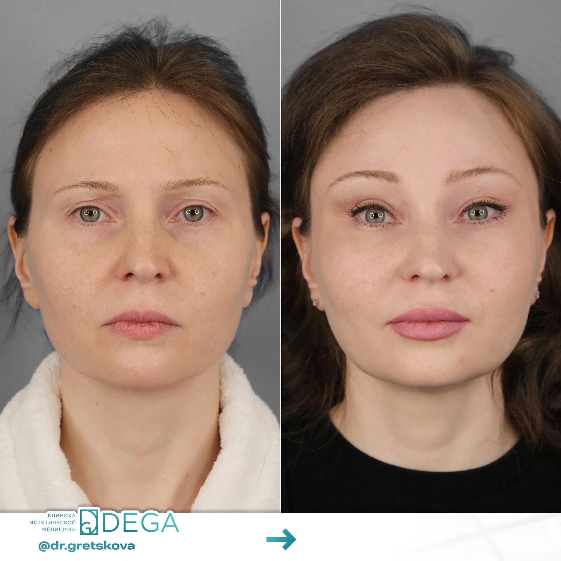 Грецкова ЕЕ - Эндоскопическая периорбитопластика, Блефаропластика, Липофилинг лица №11