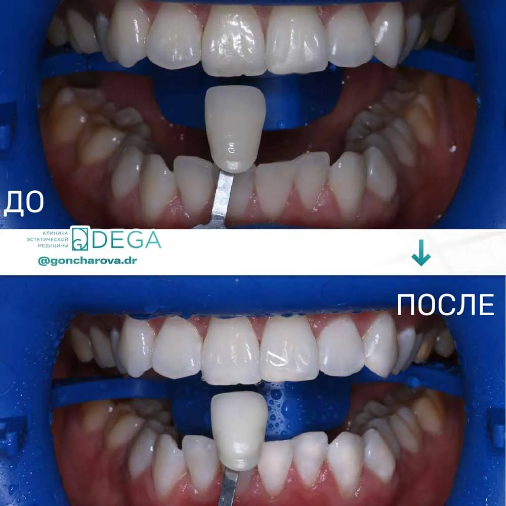 Гончарова ЮС - Отбеливание №7