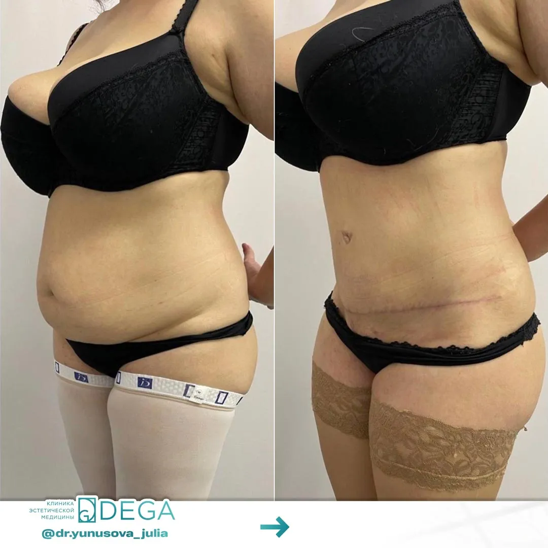 Юнусова ЮР - Абдоминопластика №2