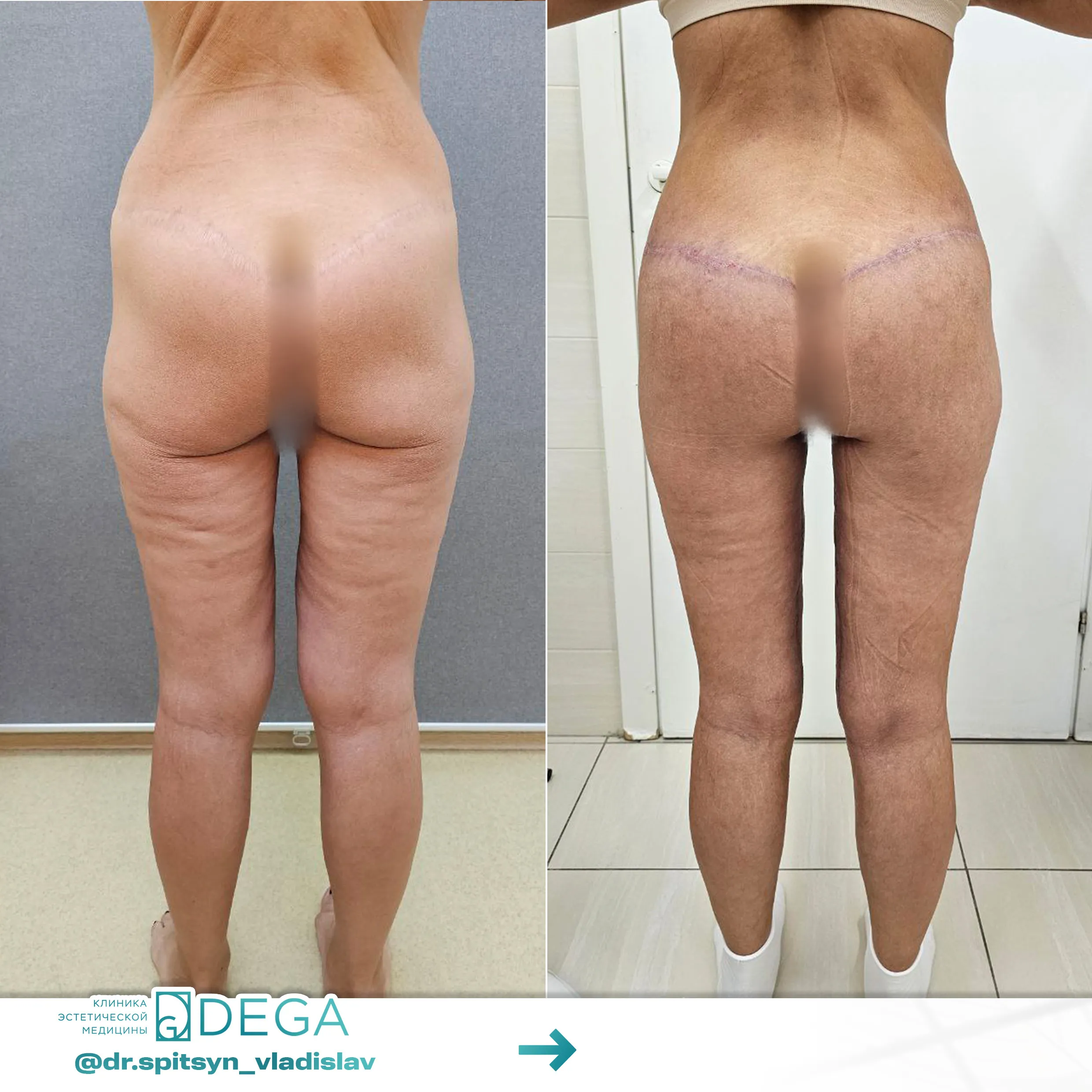 Спицын ВИ - Глютеопластика (пластика ягодиц) №56