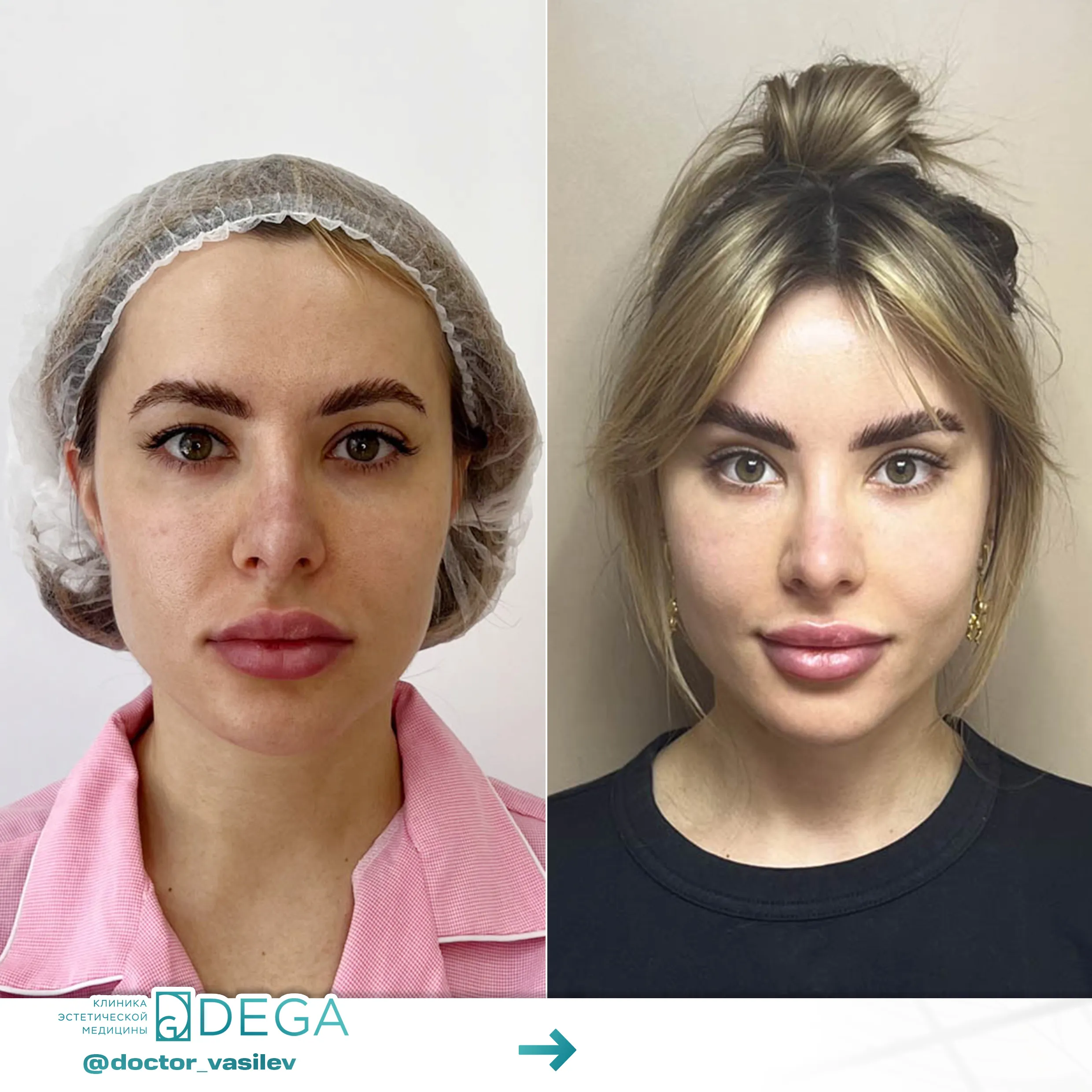 Васильев Д.О. - Блефаропластика №4