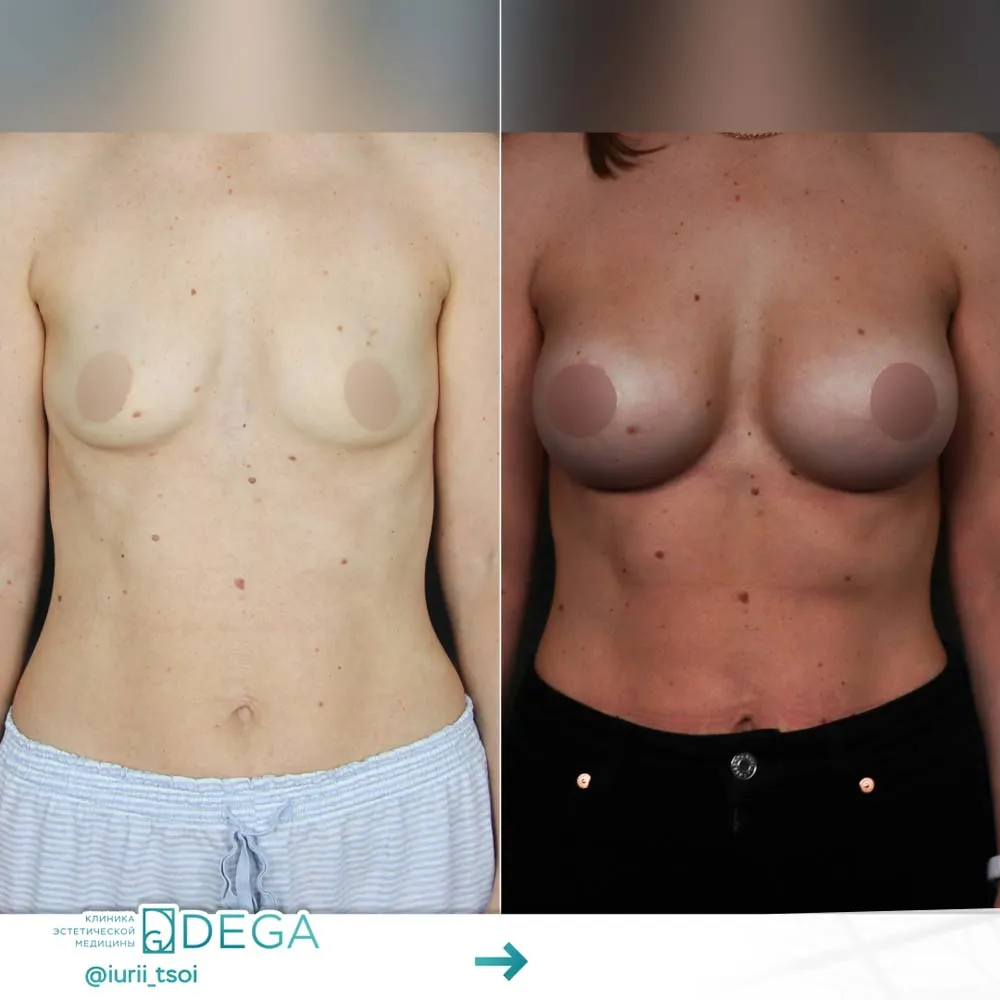 Цой ЮР - Увеличение груди №7