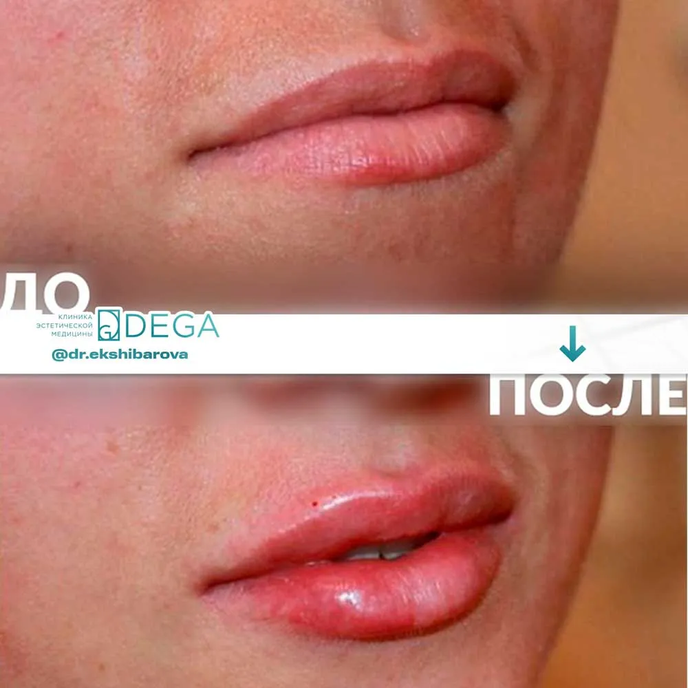 Екшибарова НИ - Контурная пластика №6