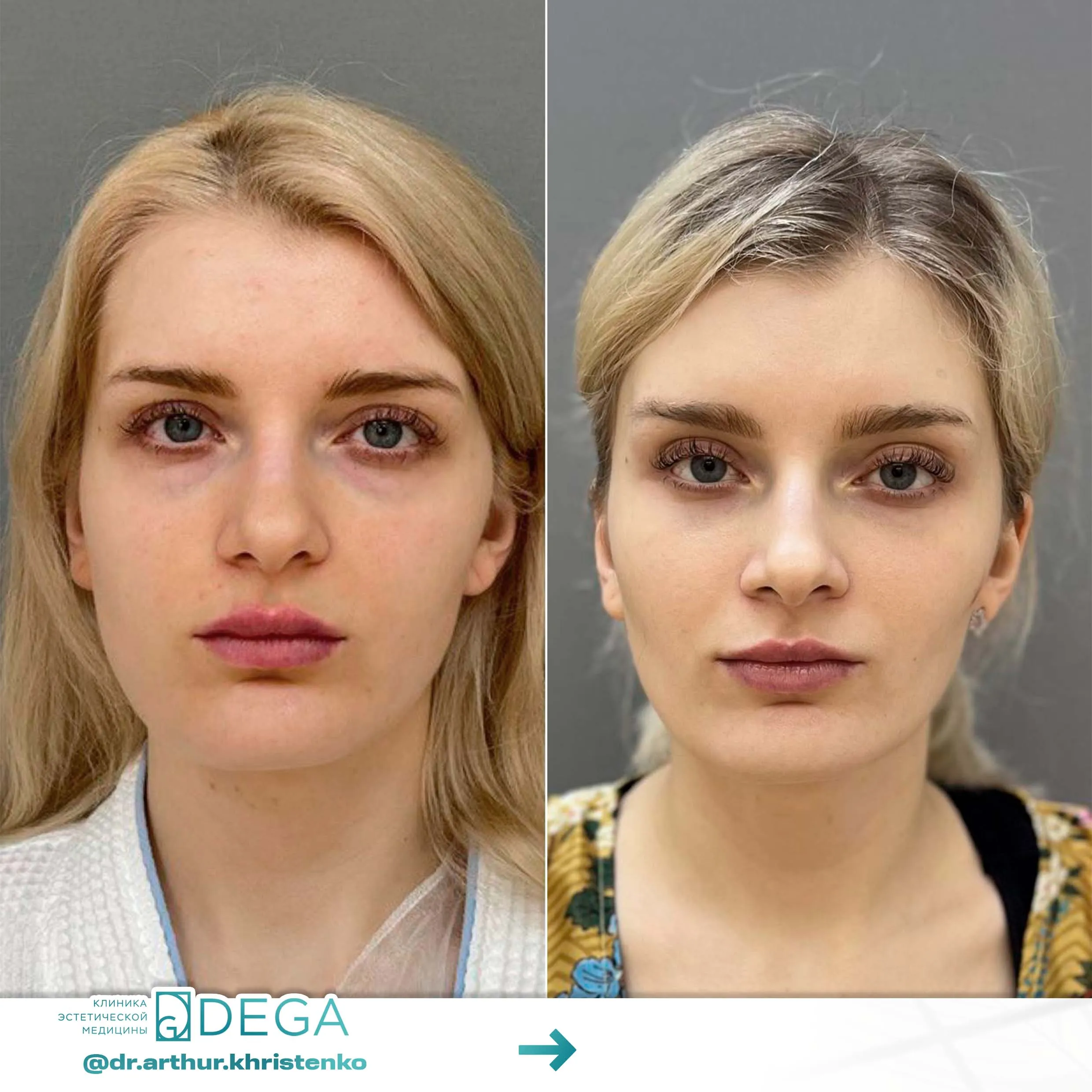 Христенко АА - Эндоскопическая периорбитопластика Блефаропластика  №22