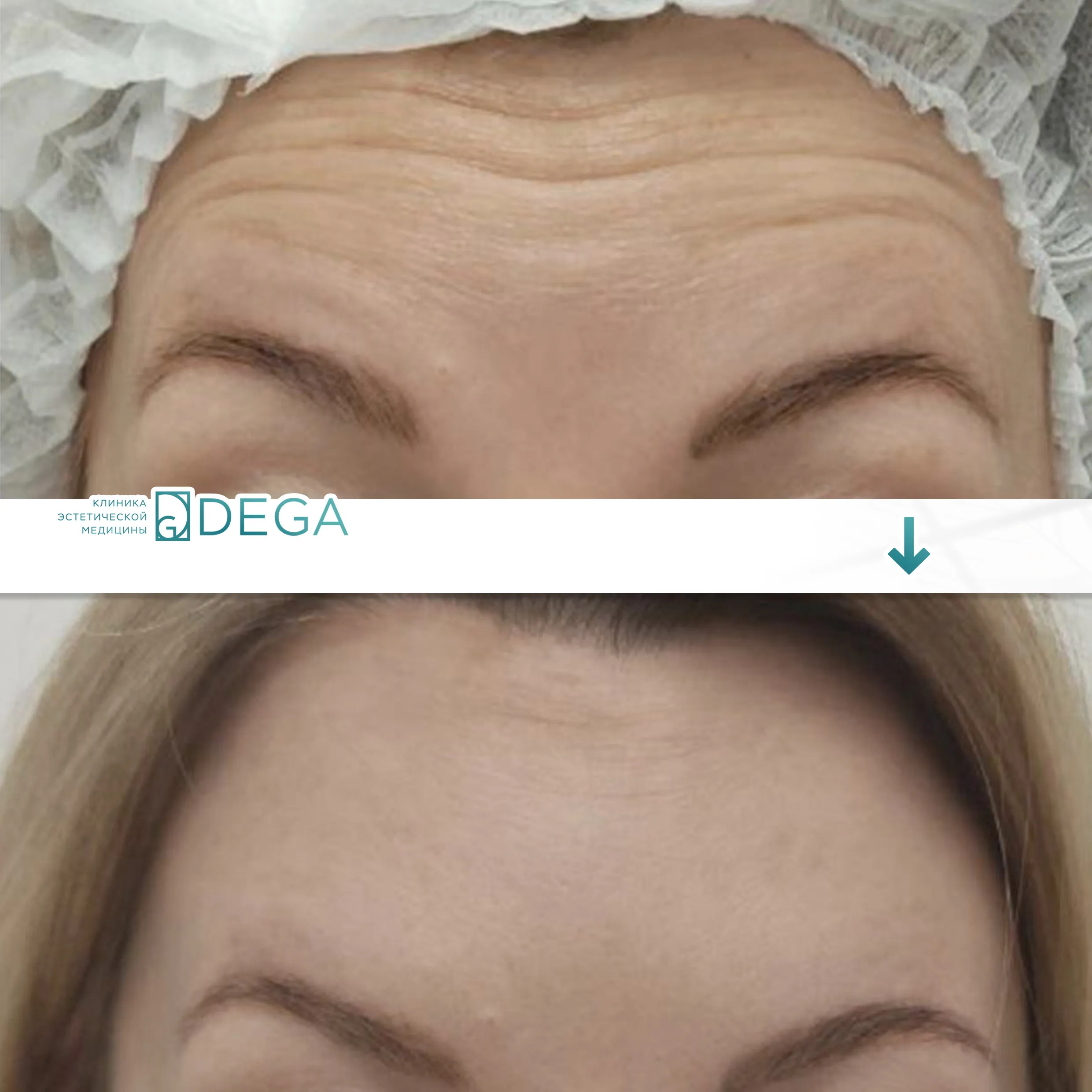 Бабичева С.Ю. — Ботокс №1