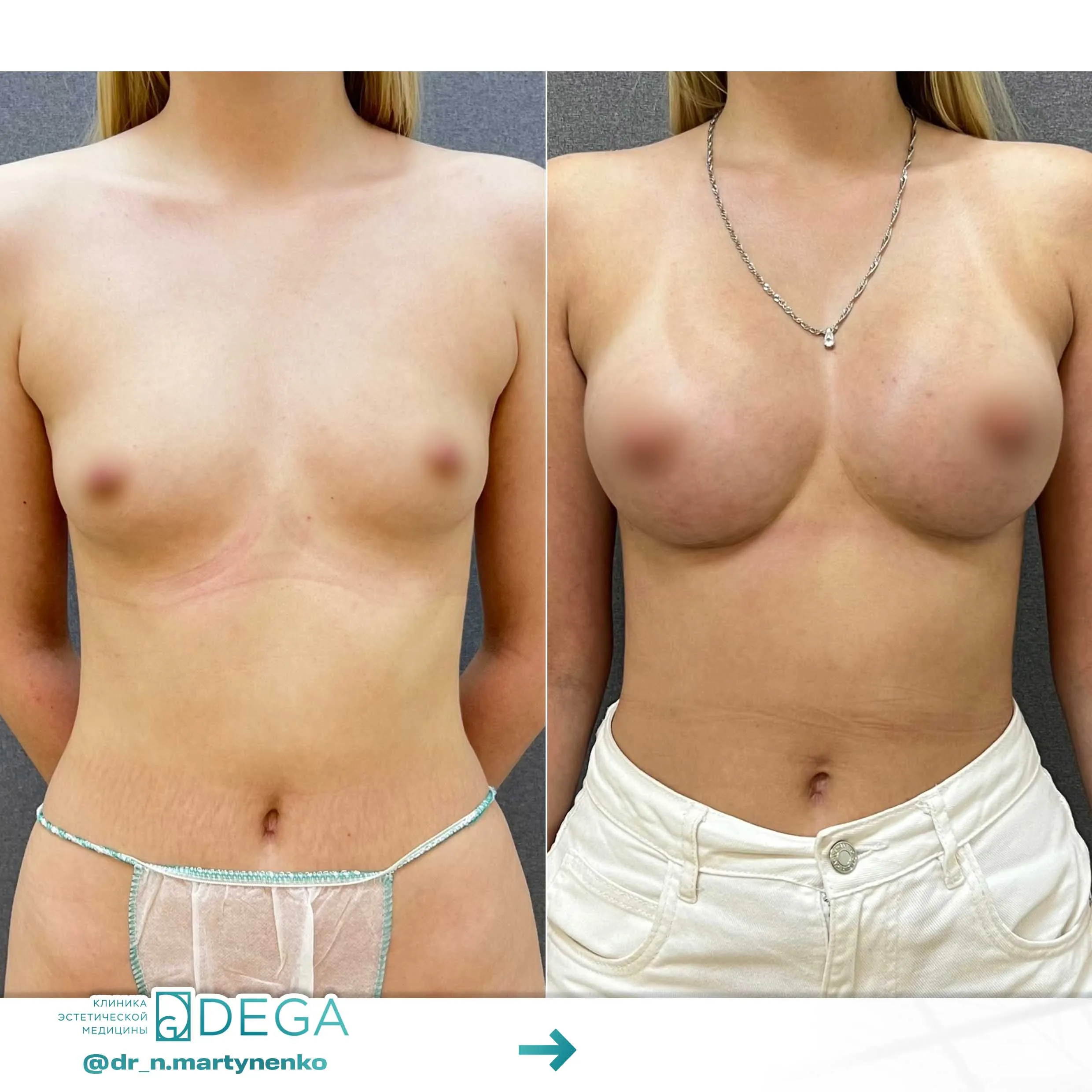 Мартыненко Н. А. —  №8 Увеличение груди Маммопластика