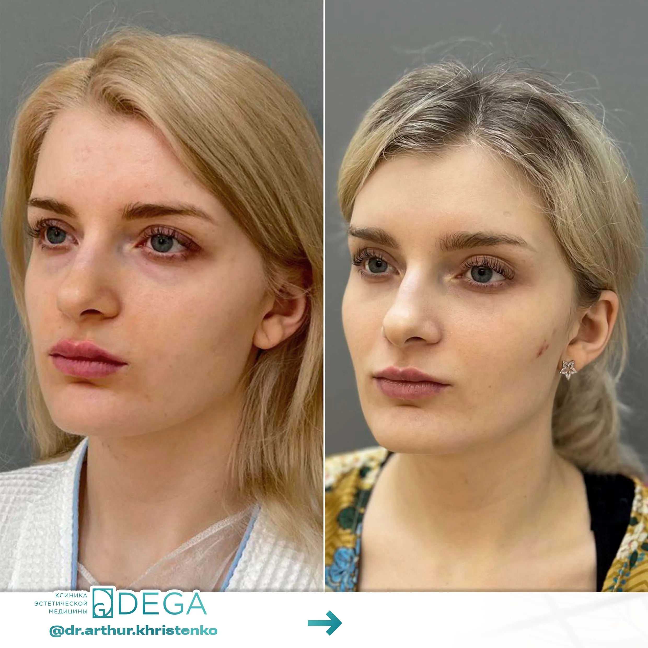 Христенко АА - Эндоскопическая периорбитопластика, Блефаропластика №22