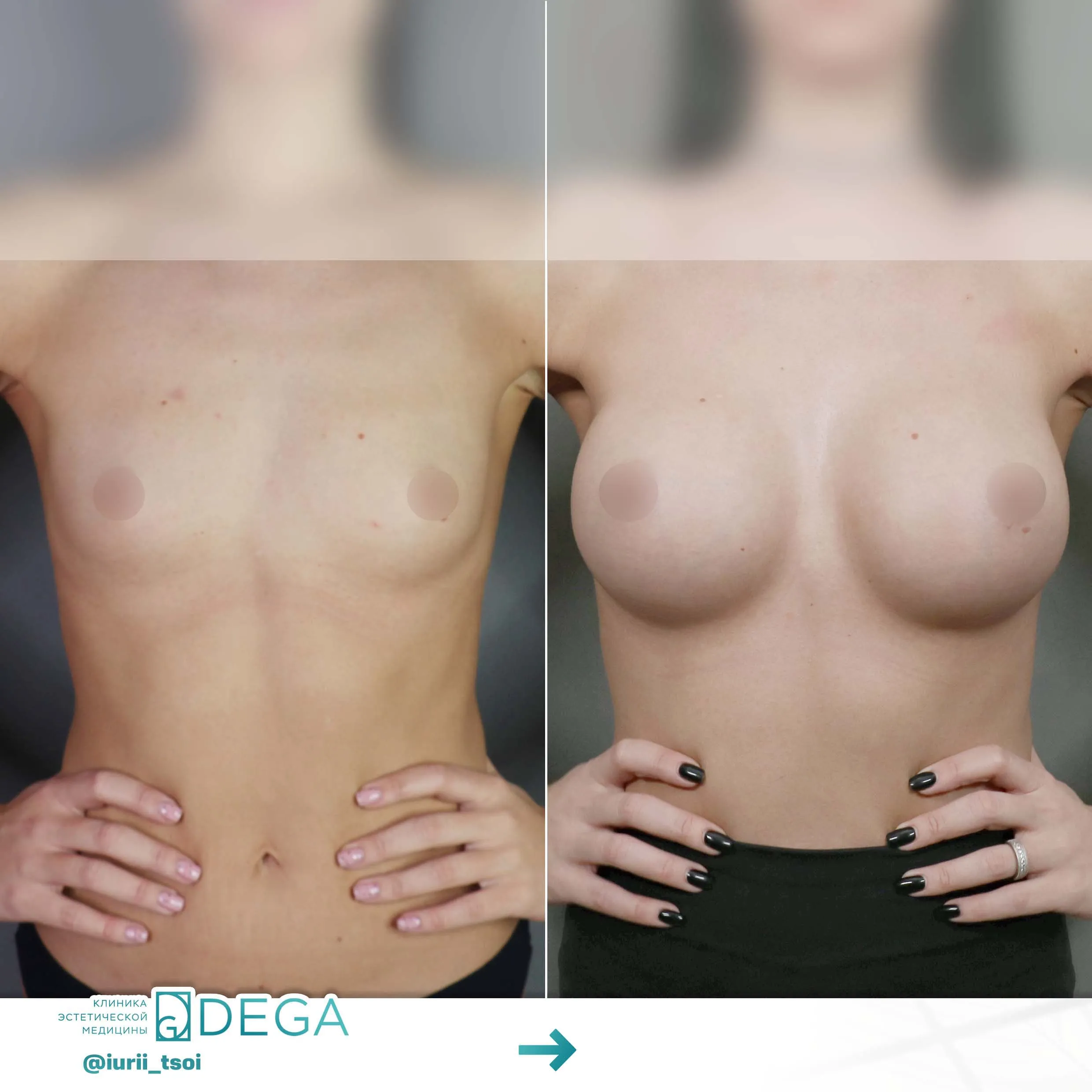Цой ЮР - Увеличение груди №11