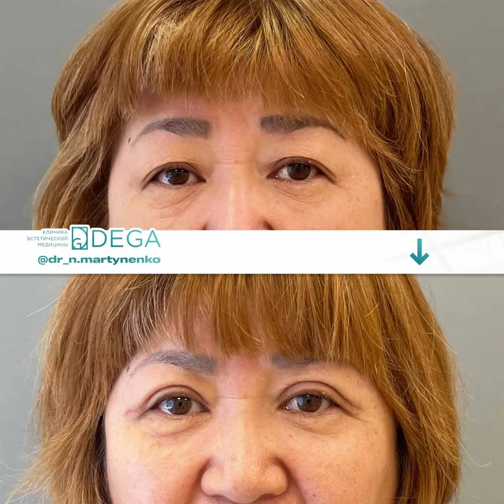 Мартыненко Н. А. — №14 Блефаропластика верхних век