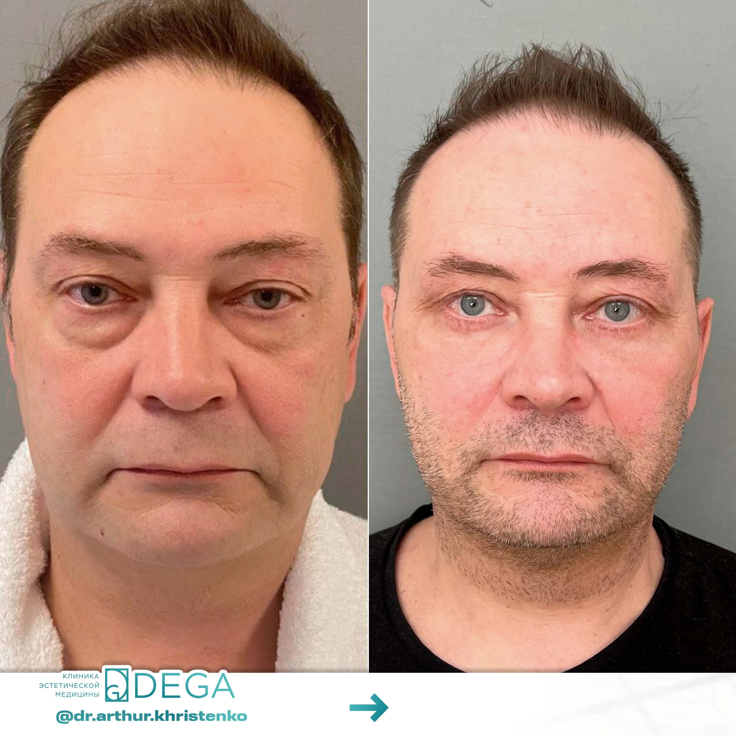 Христенко АА -Эндоскопическая подтяжка, Блефаропластика, Комки Биша №29