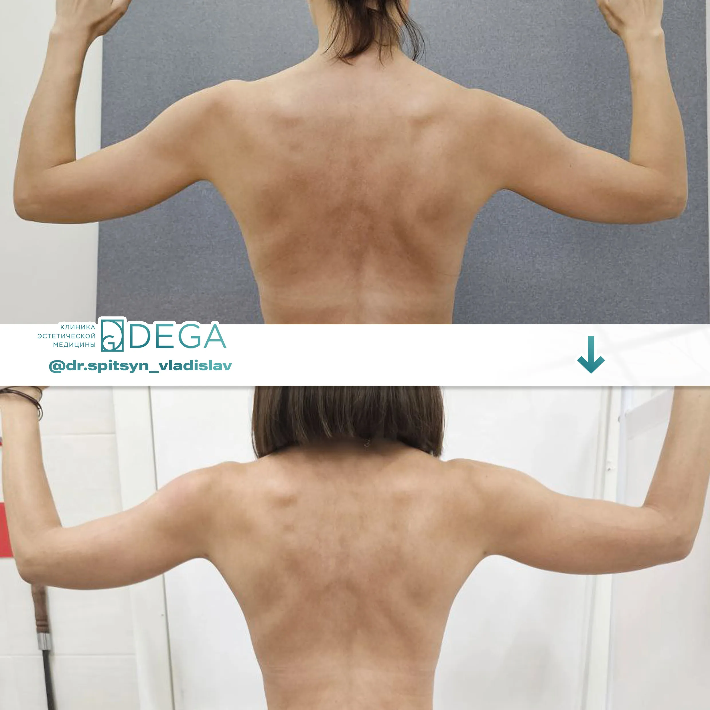 Спицын ВИ - Мастопексия (подтяжка груди), Липосакция рук, Липофилинг груди №50