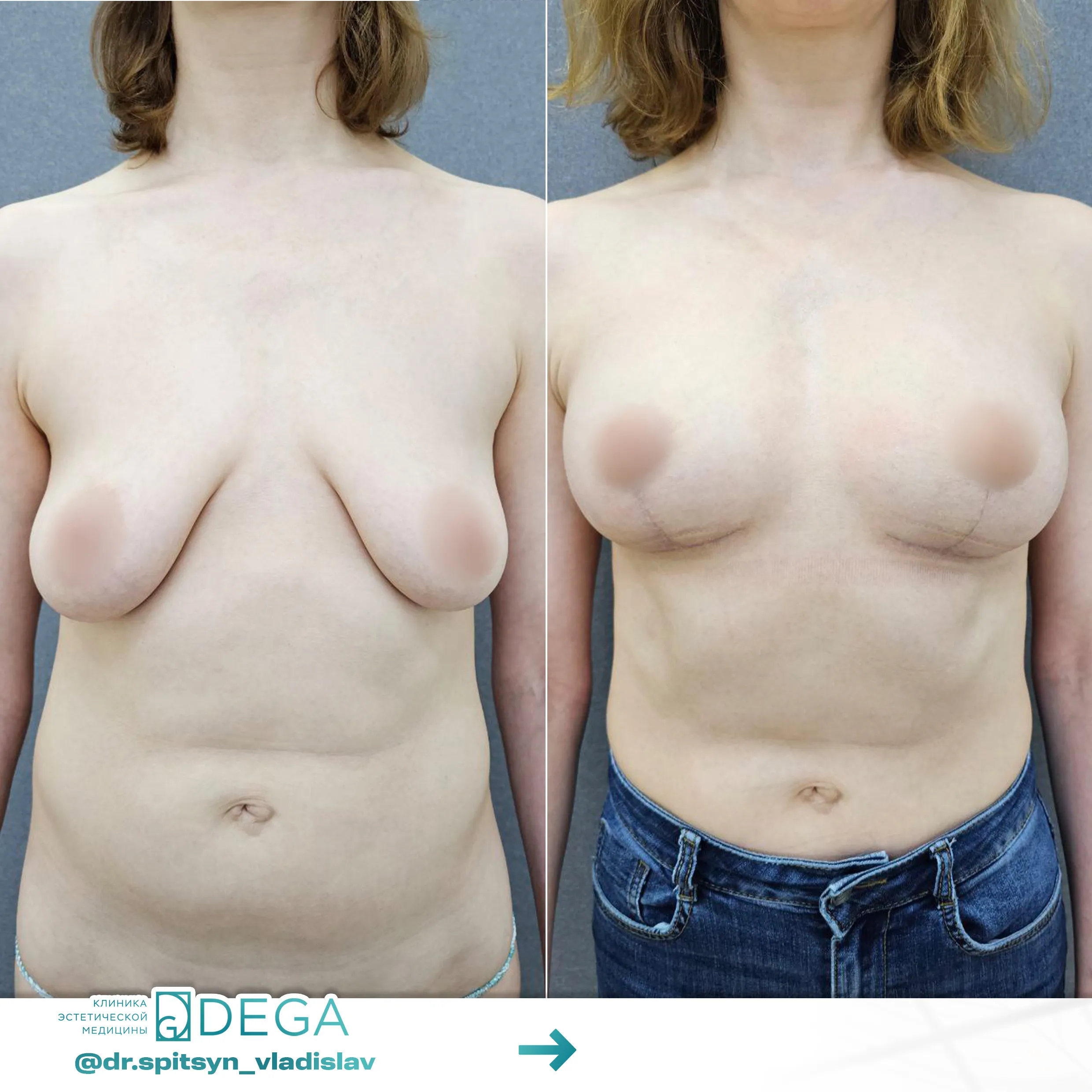 Спицын ВИ - Мастопексия (подтяжка груди) №47