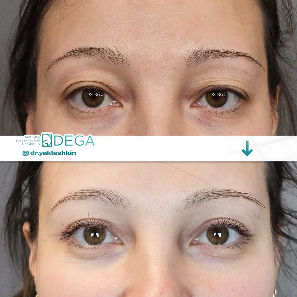 Яклашкин АВ - Блефаропластика №3