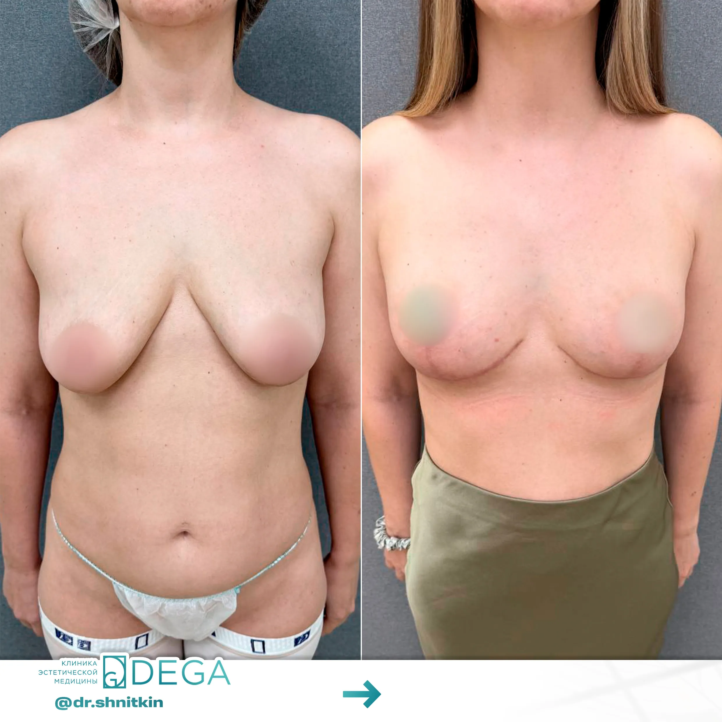 Шниткин Антон Сергеевич - Мастопексия (подтяжка груди) №25