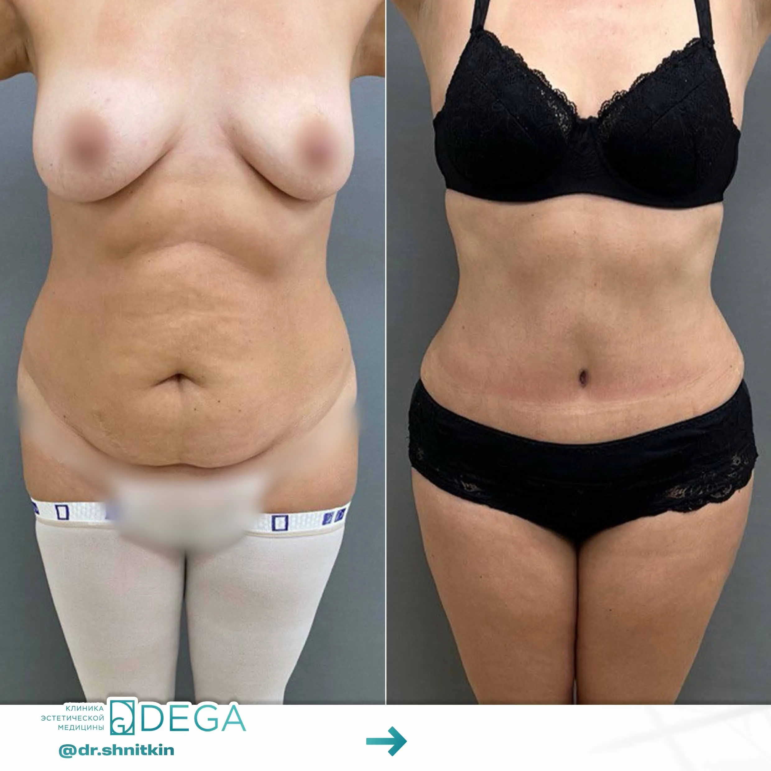 Шниткин Антон Сергеевич №19.1 Абдоминопластика (пластика живота) Пластика тела