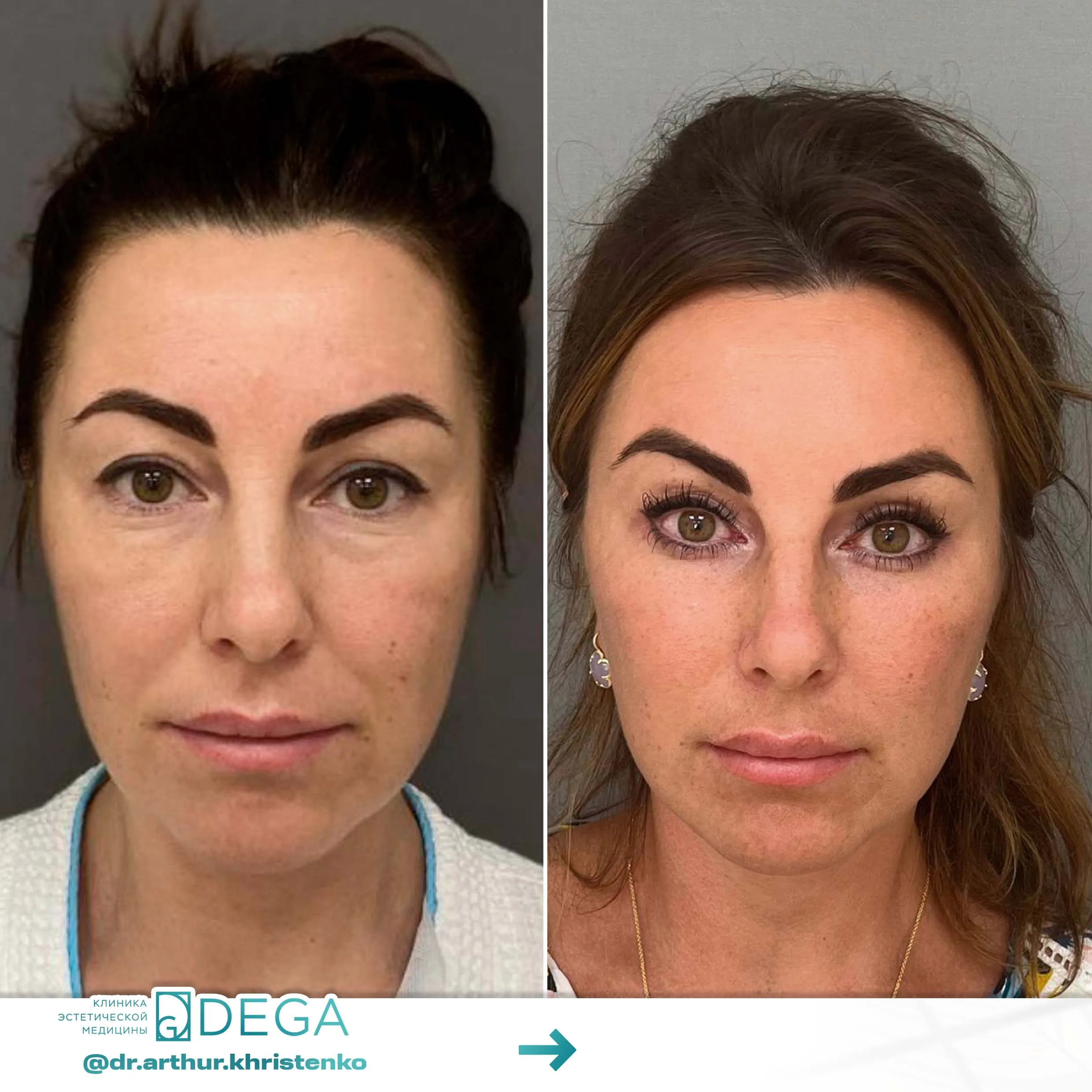 Христенко АА - ESP-Lifting, Эндоскопическая подтяжка, Фейслифтинг, Платизмопластика №23