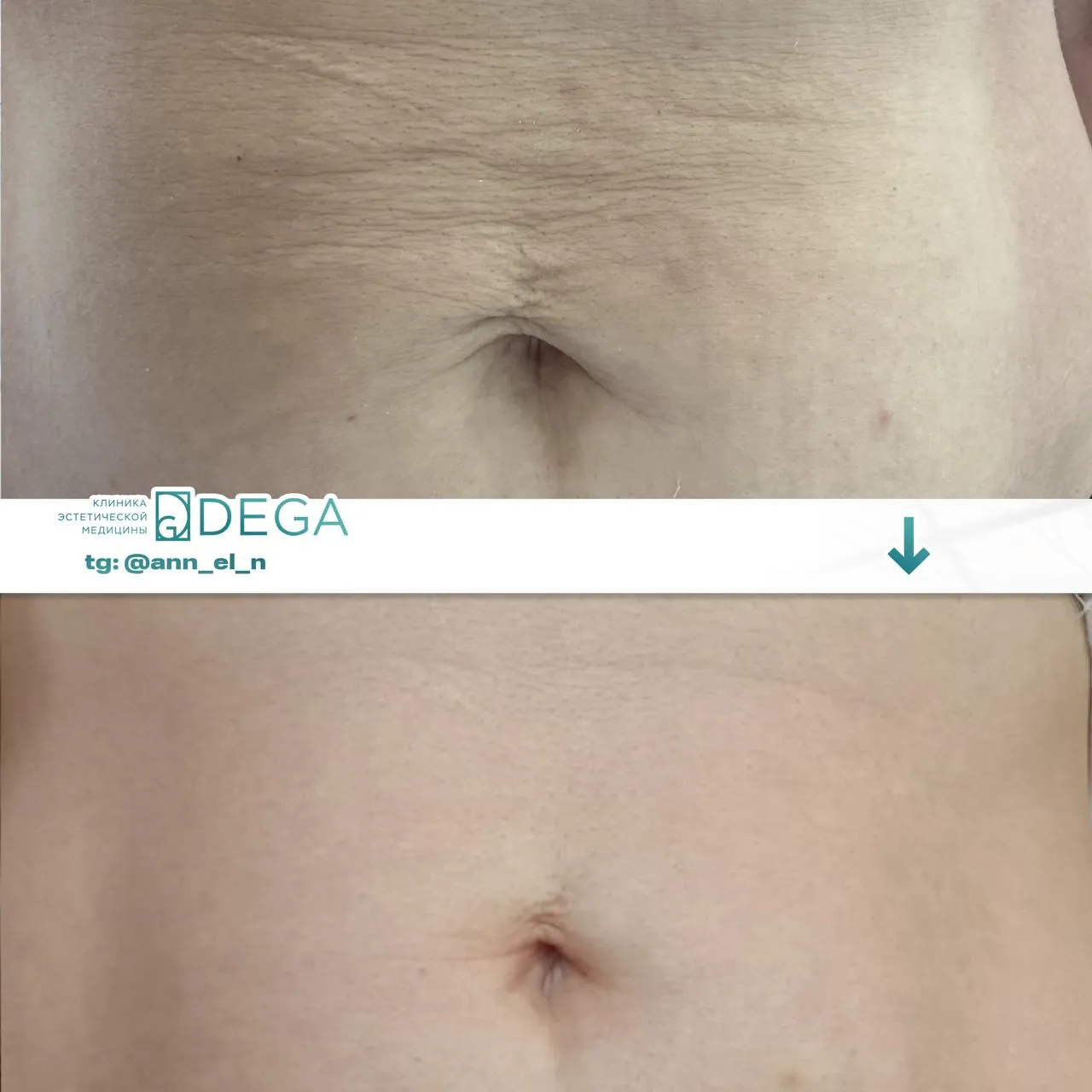 Дулмаева А.О. - Микроигольчатый RF-лифтинг №7