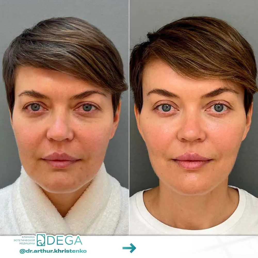 Христенко АА - Эндоскопическая периорбитопластика №12