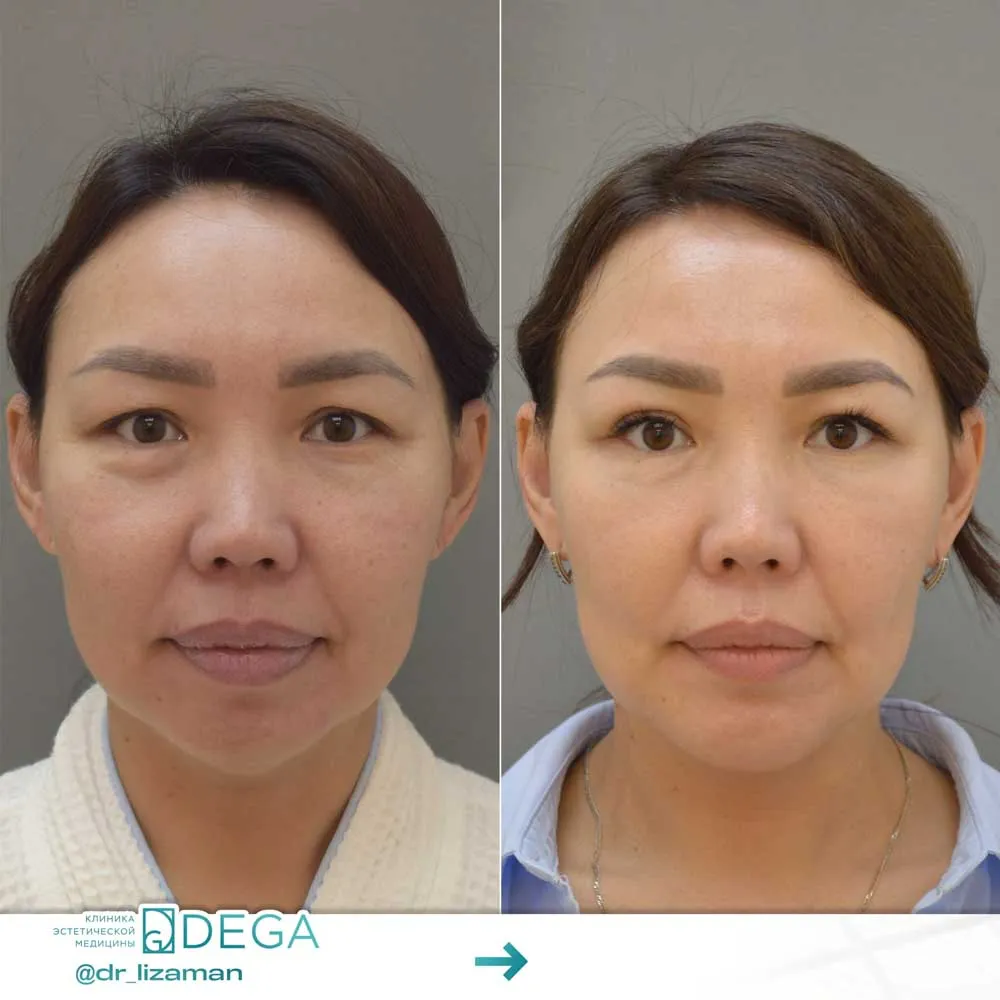 Манашева ЕБ - Блефаропластика верх+низ, Платизмопластика, Гениопластика №6