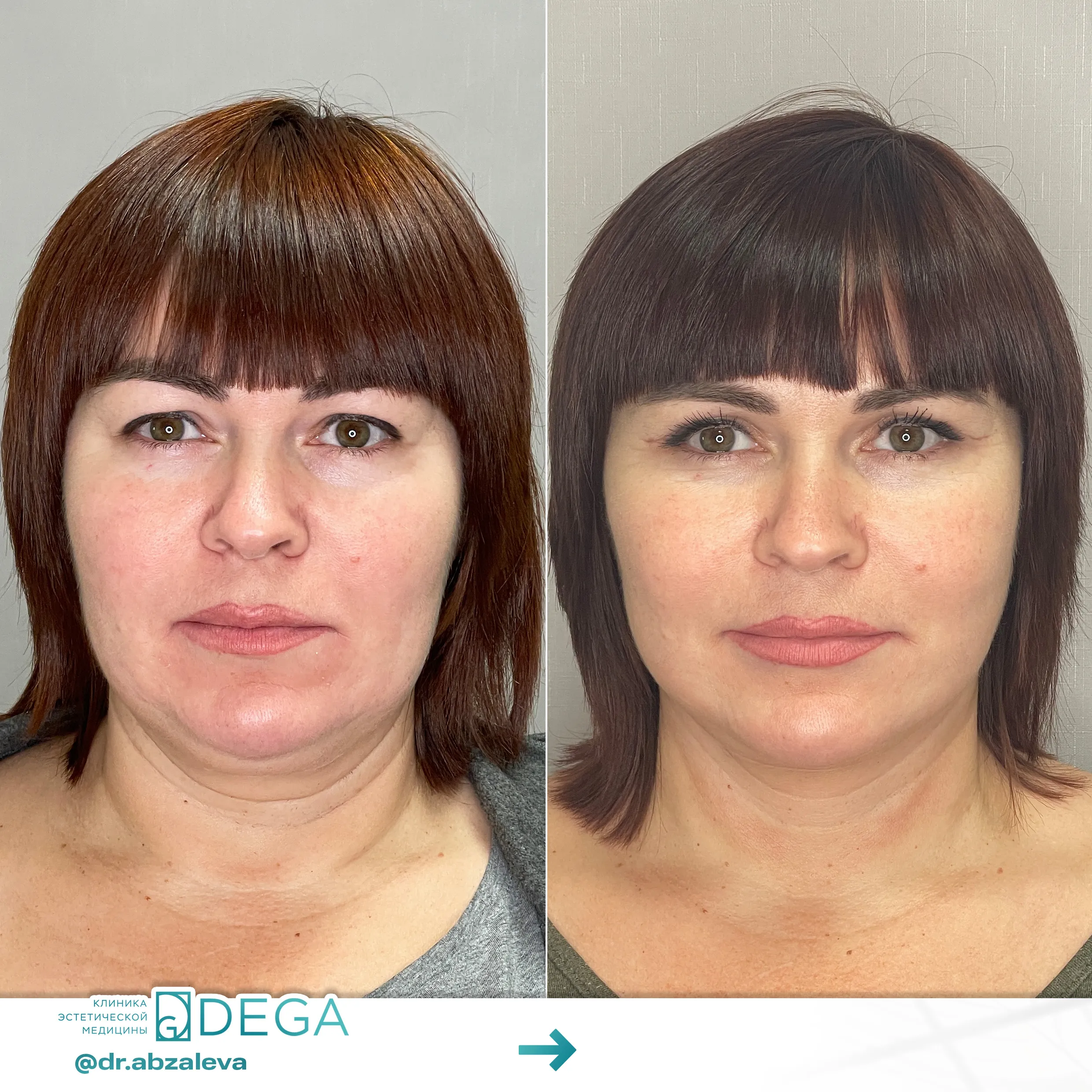 Абзалева Г.Р. - Эндоскопическая подтяжка лица №1