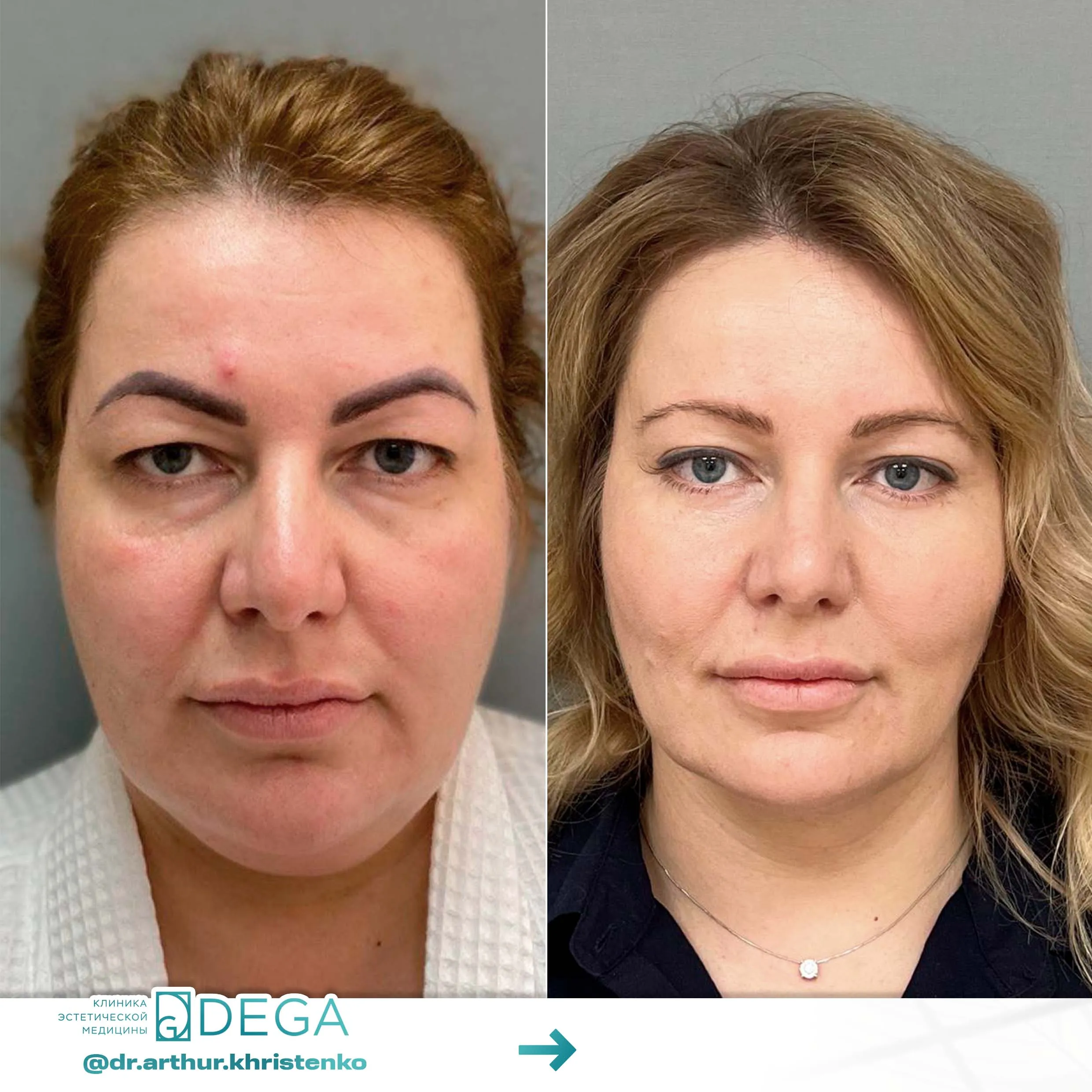 Христенко АА -  Эндоскопическая подтяжка, Блефаропластика, Липосакция, Комки Биша №25