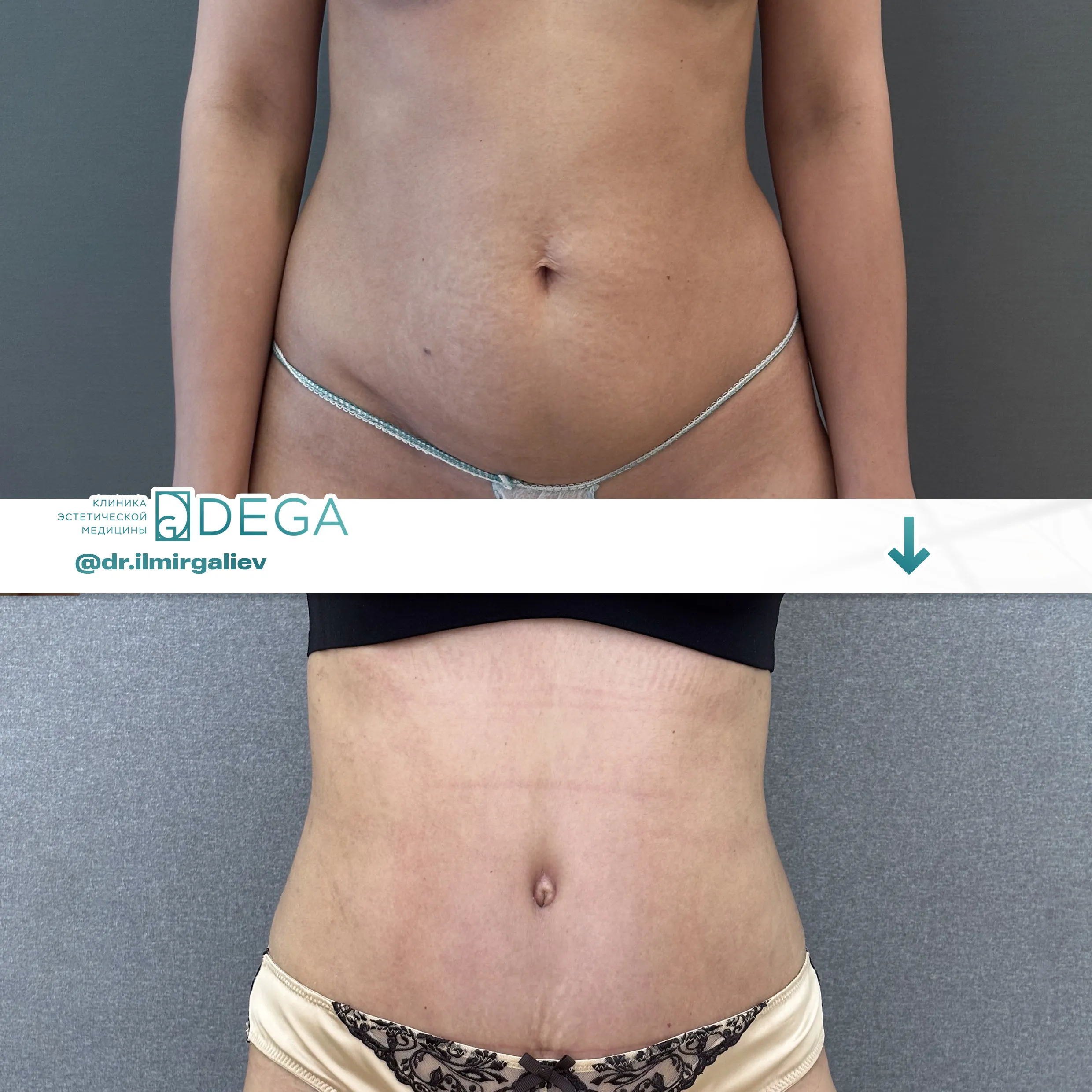 Галиев Ильмир Амирович - Абдоминопластика №11