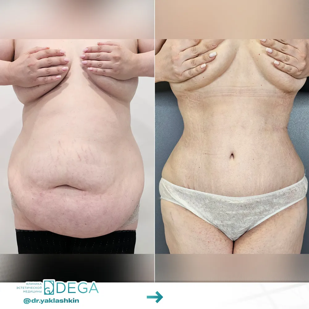 Яклашкин АВ - Абдоминопластика №1