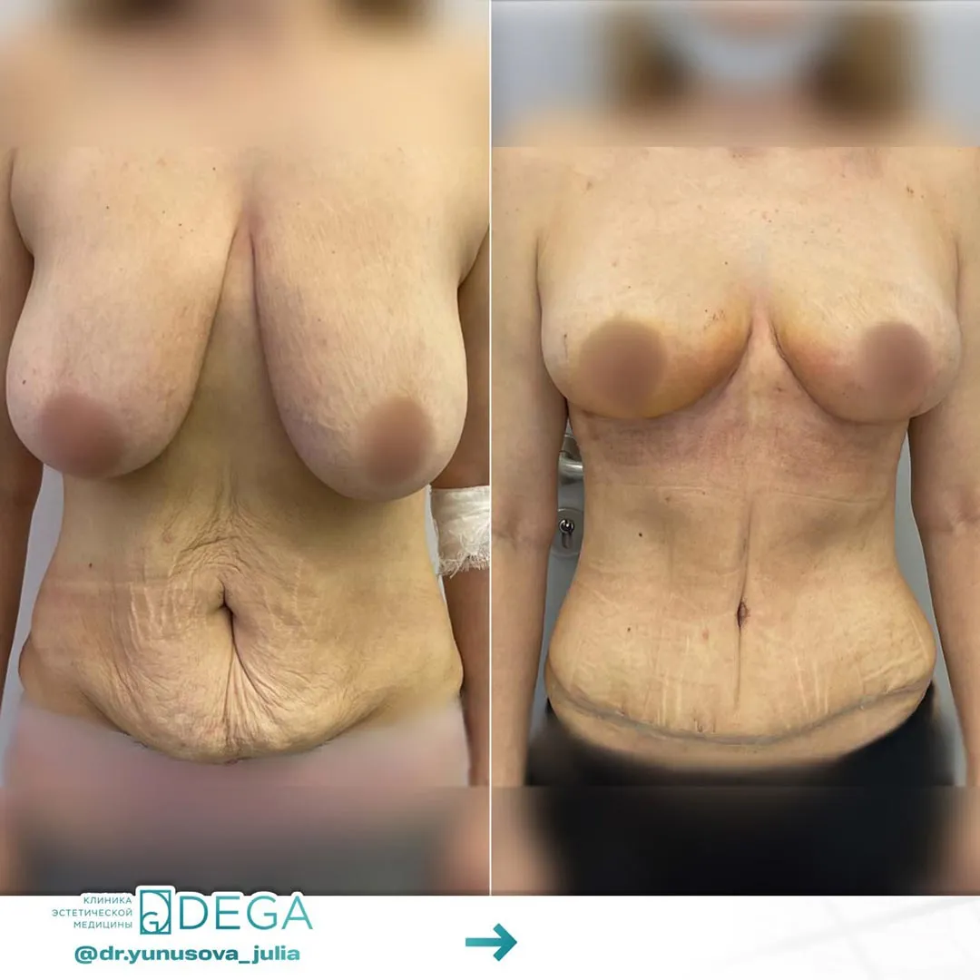 Юнусова ЮР - Абдоминопластика, Мастопексия №3