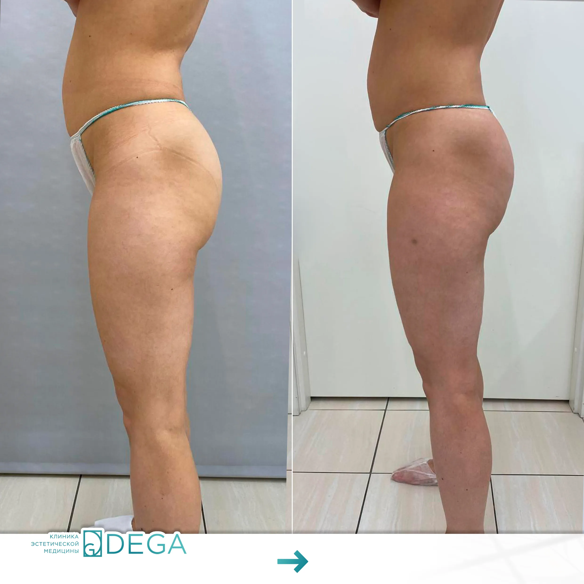 Горновая О.A. - Лазерный липолиз №1