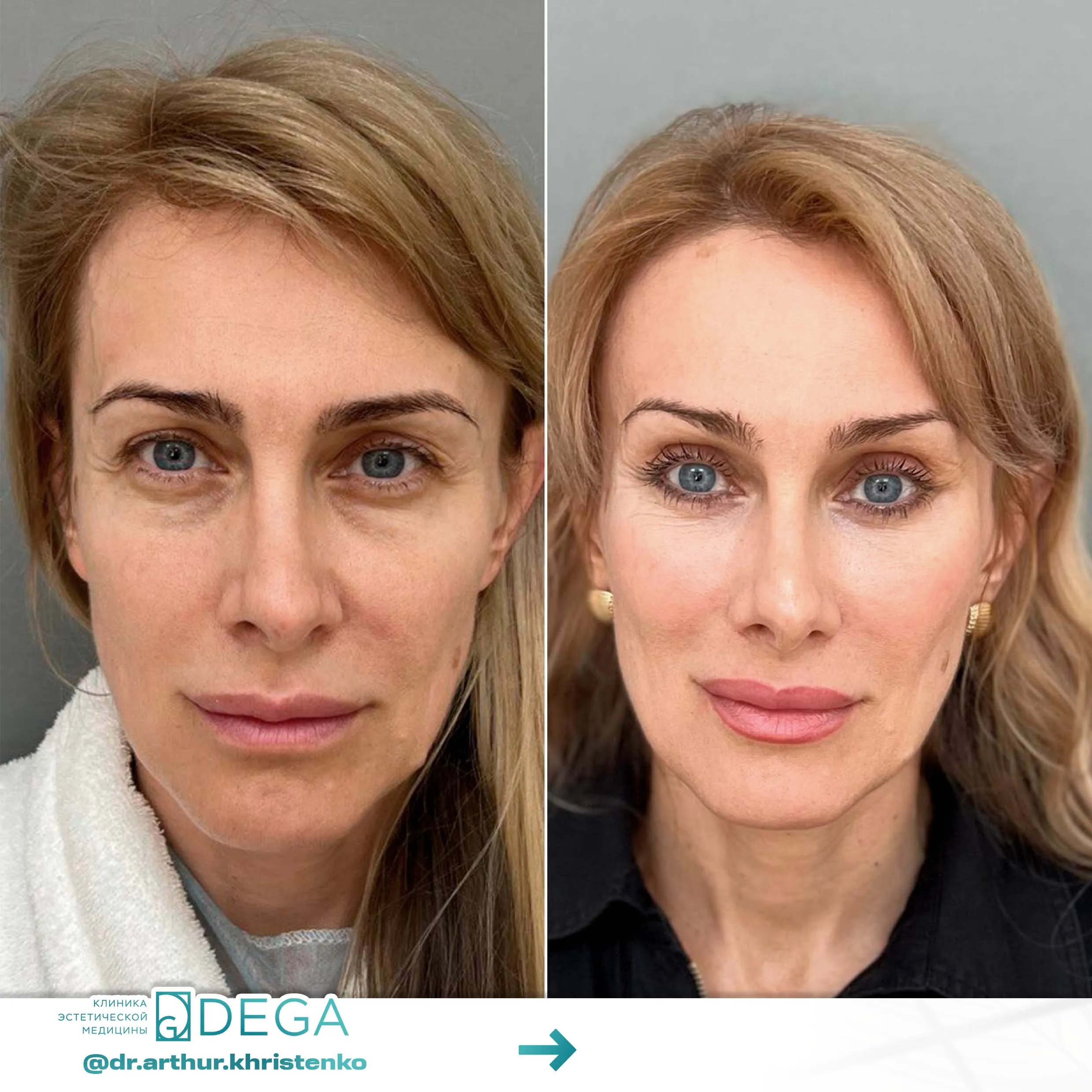 Христенко АА - ESP-Lifting, Эндоскопическая подтяжка, Фейслифтинг, Платизмопластика №24