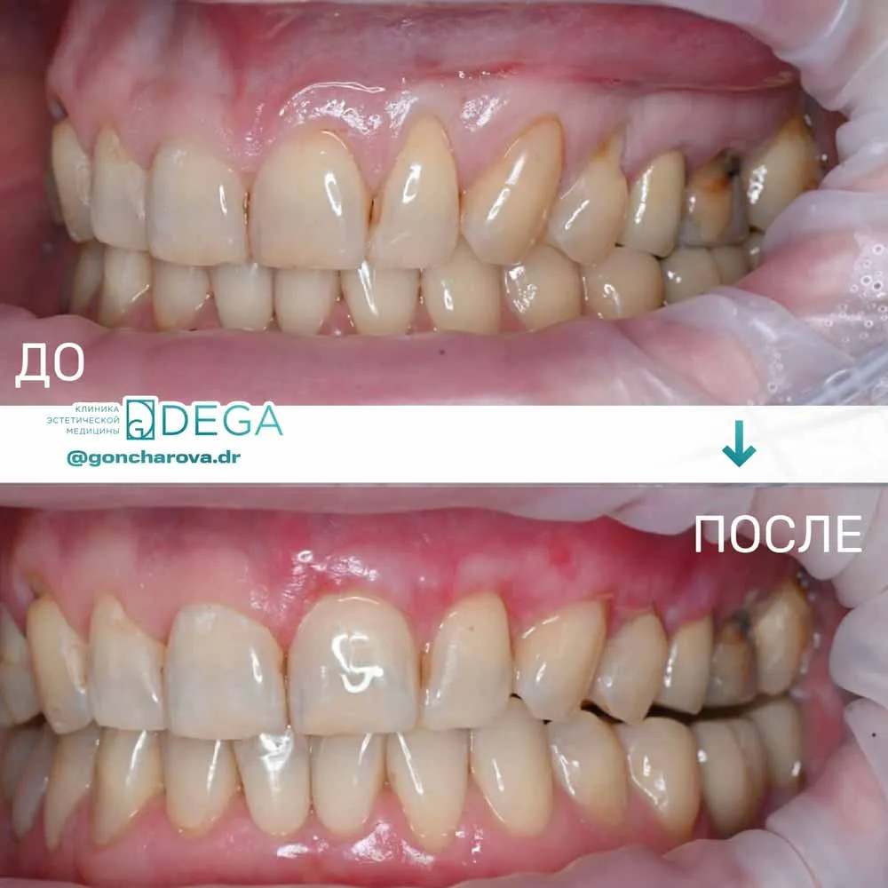 Гончарова ЮС - Пластика рецессии №1