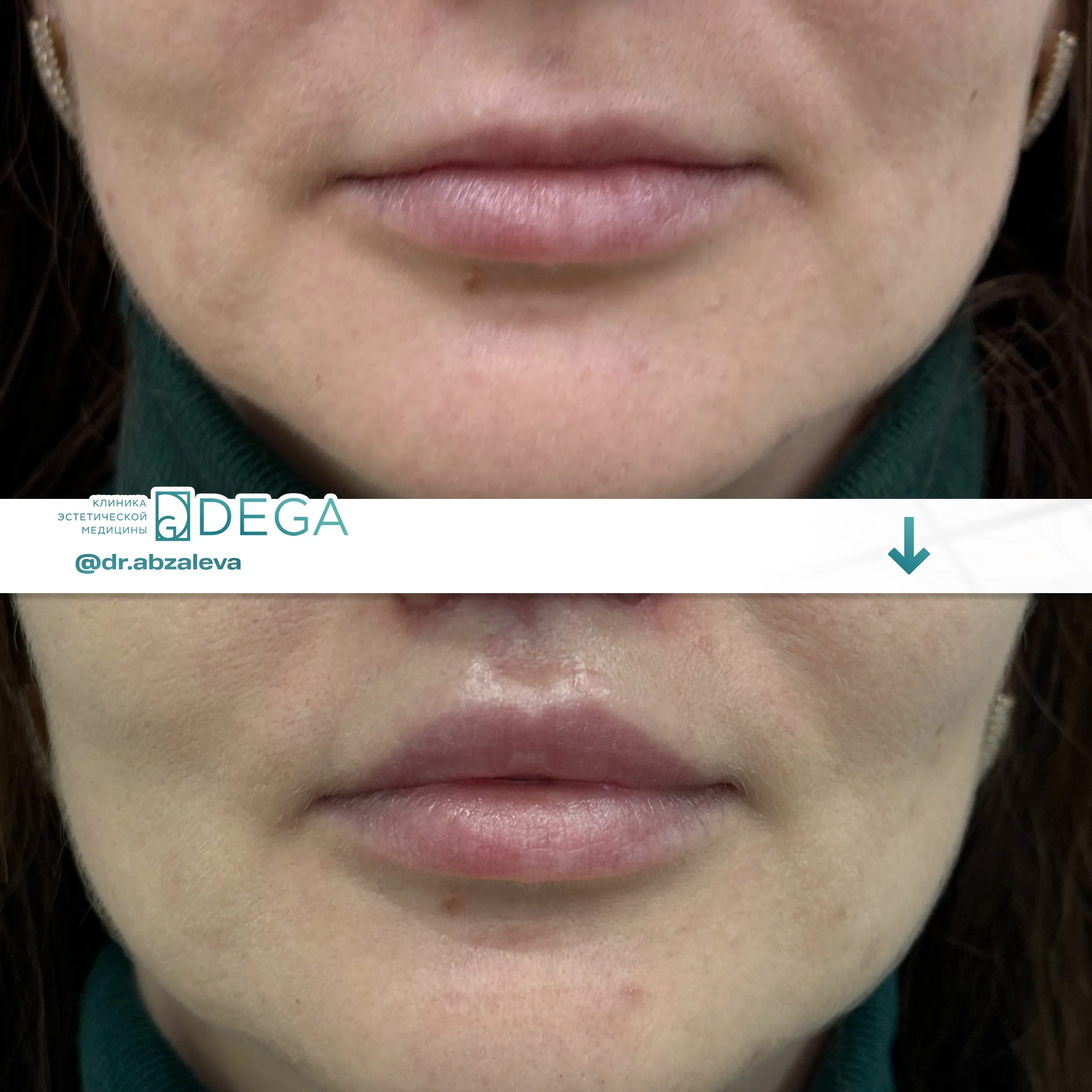 Абзалева Г.Р. - Хейлопластика №7