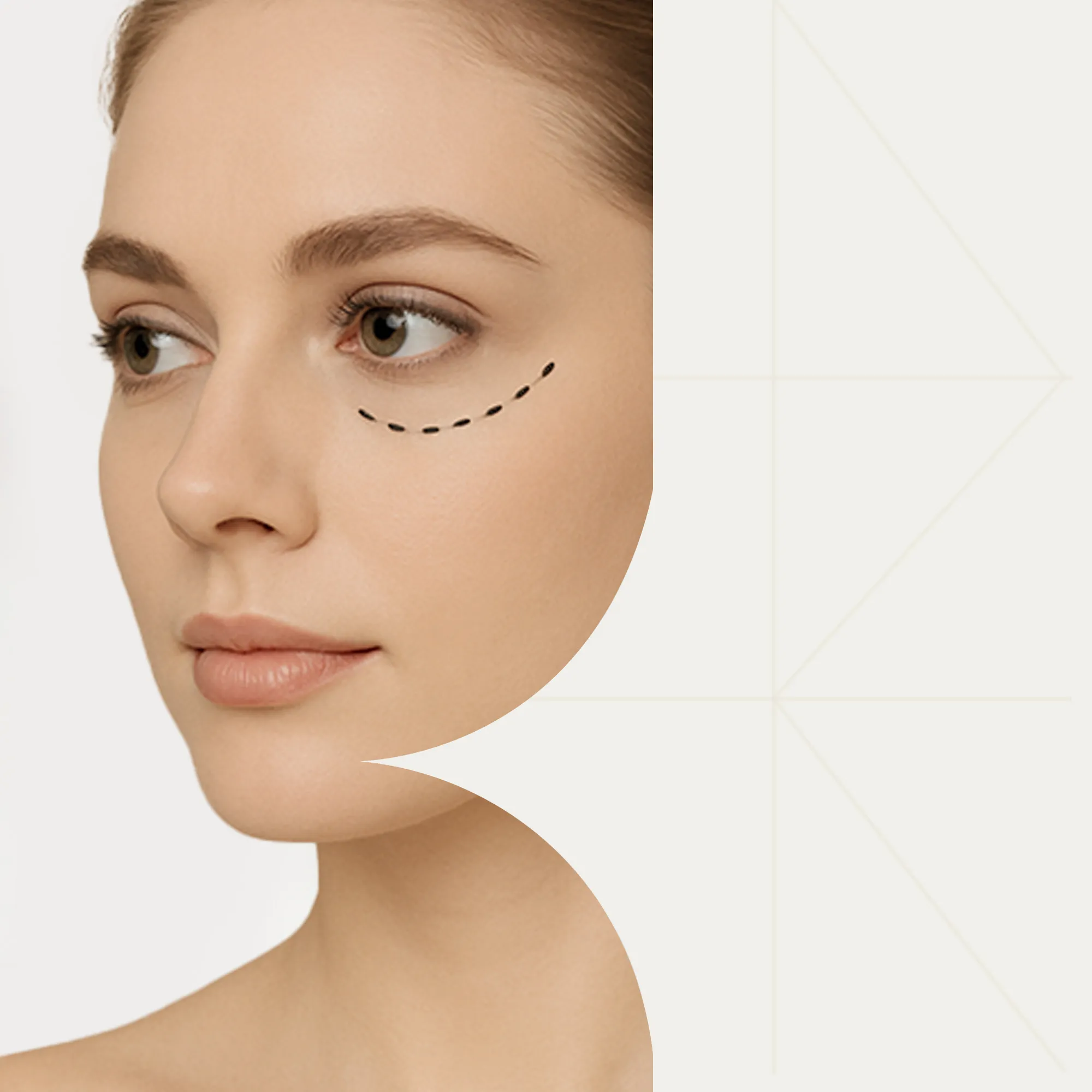 Красота в ваших глазах: блефоропластика