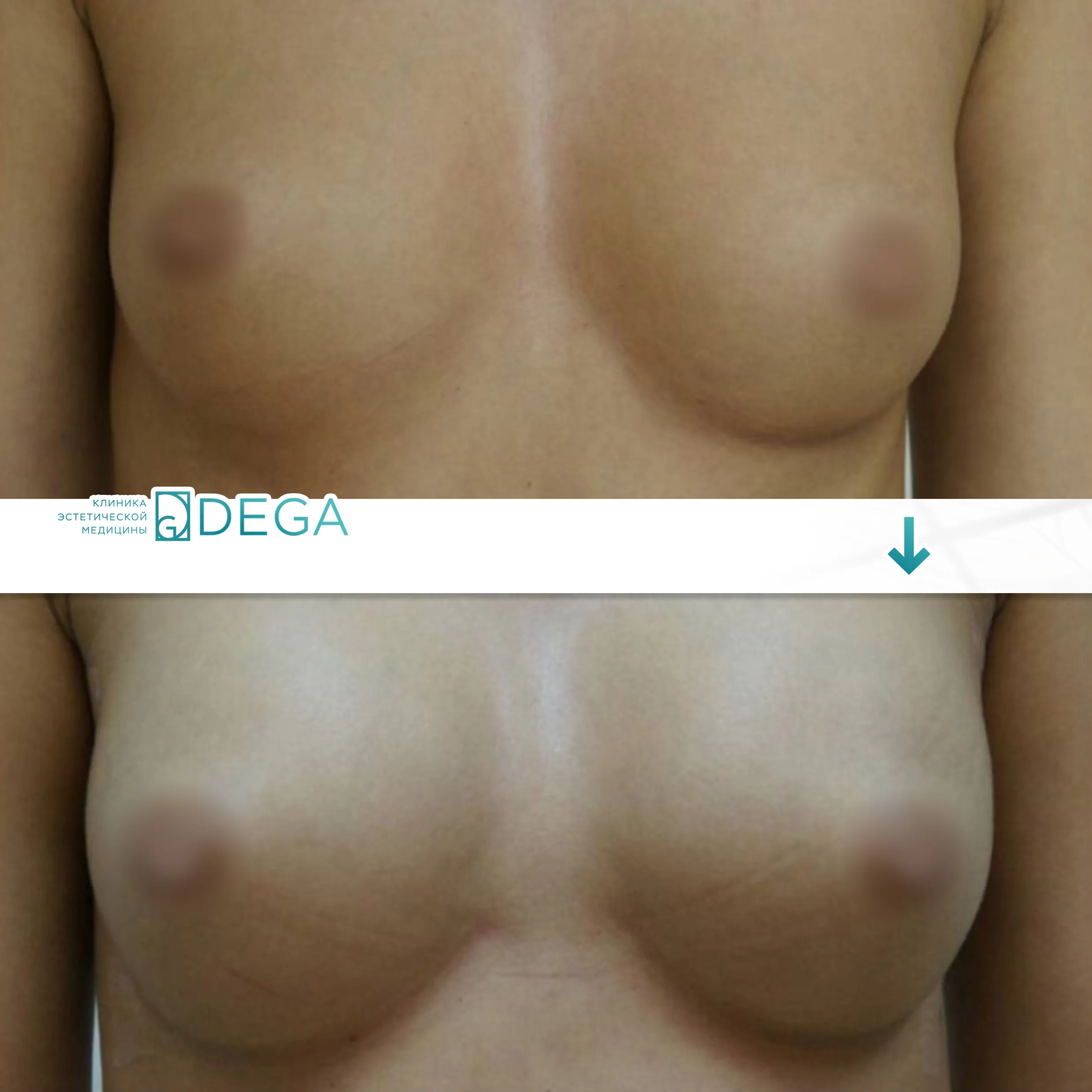 Шорников Евгений Сергеевич №7.1 Маммопластика Липофилинг груди