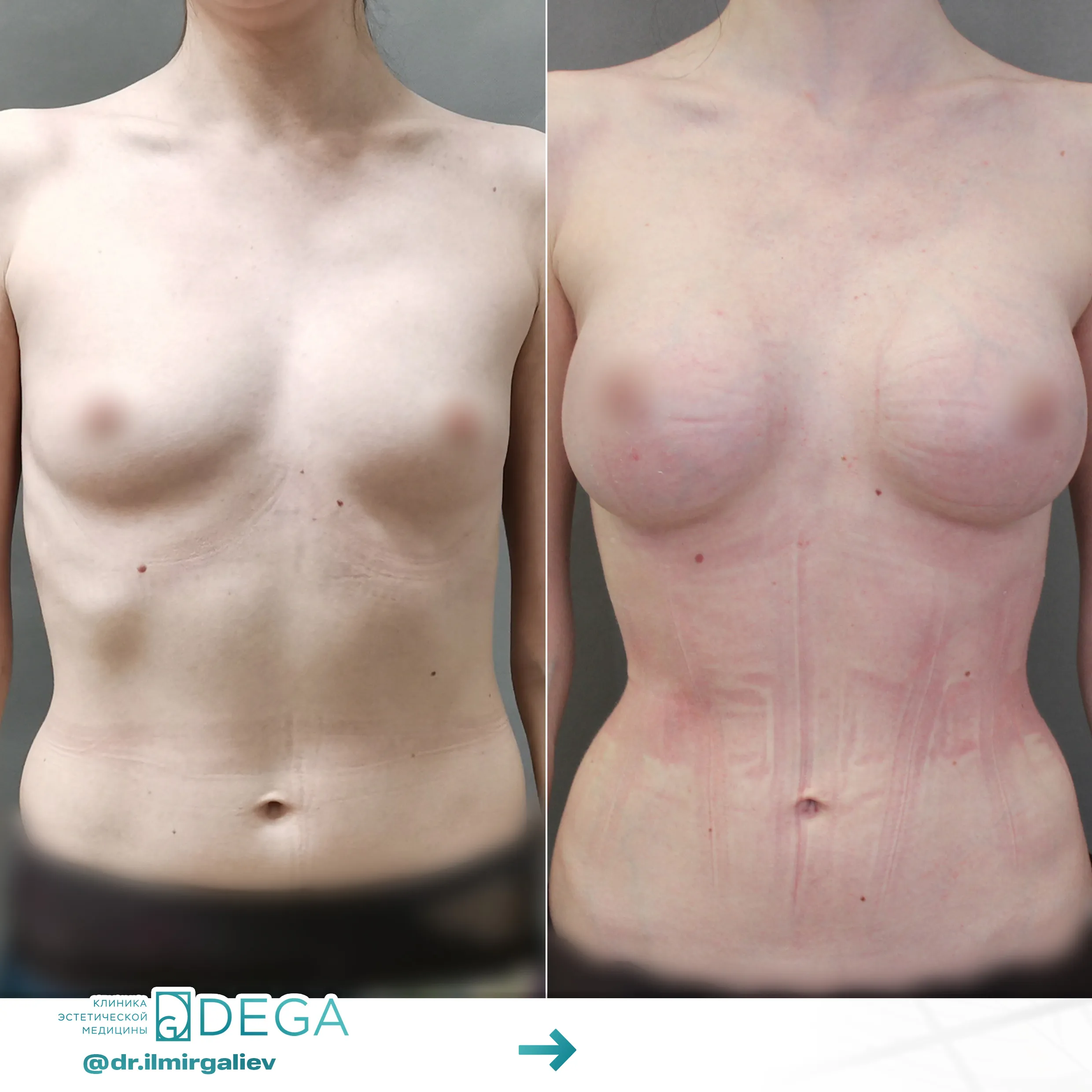Галиев Ильмир Амирович №5.1 Маммопластика Увеличение груди Липосакция тела Сужение талии