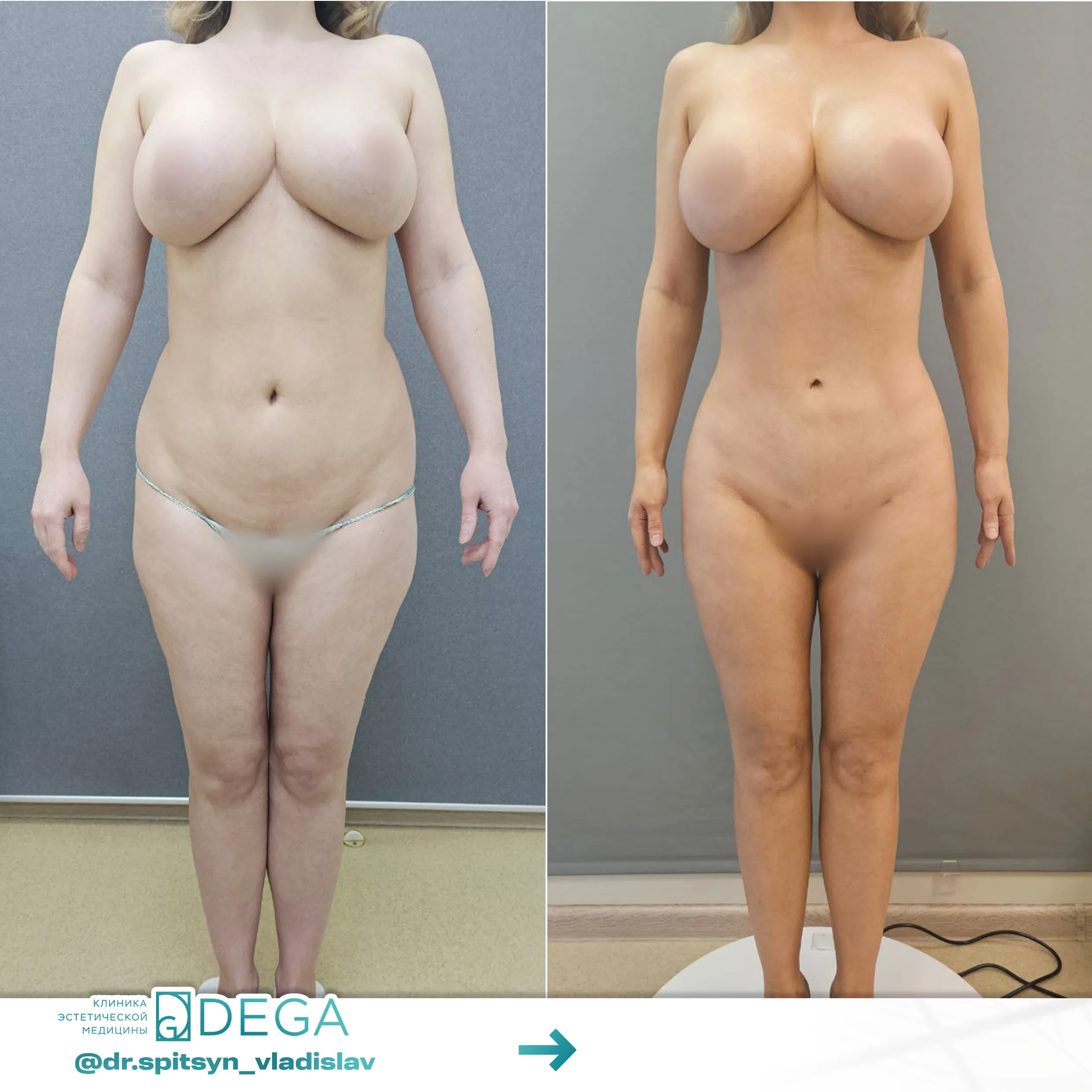 Спицын ВИ - Липосакция тела, Липофилинг тела, Липофилинг груди №53