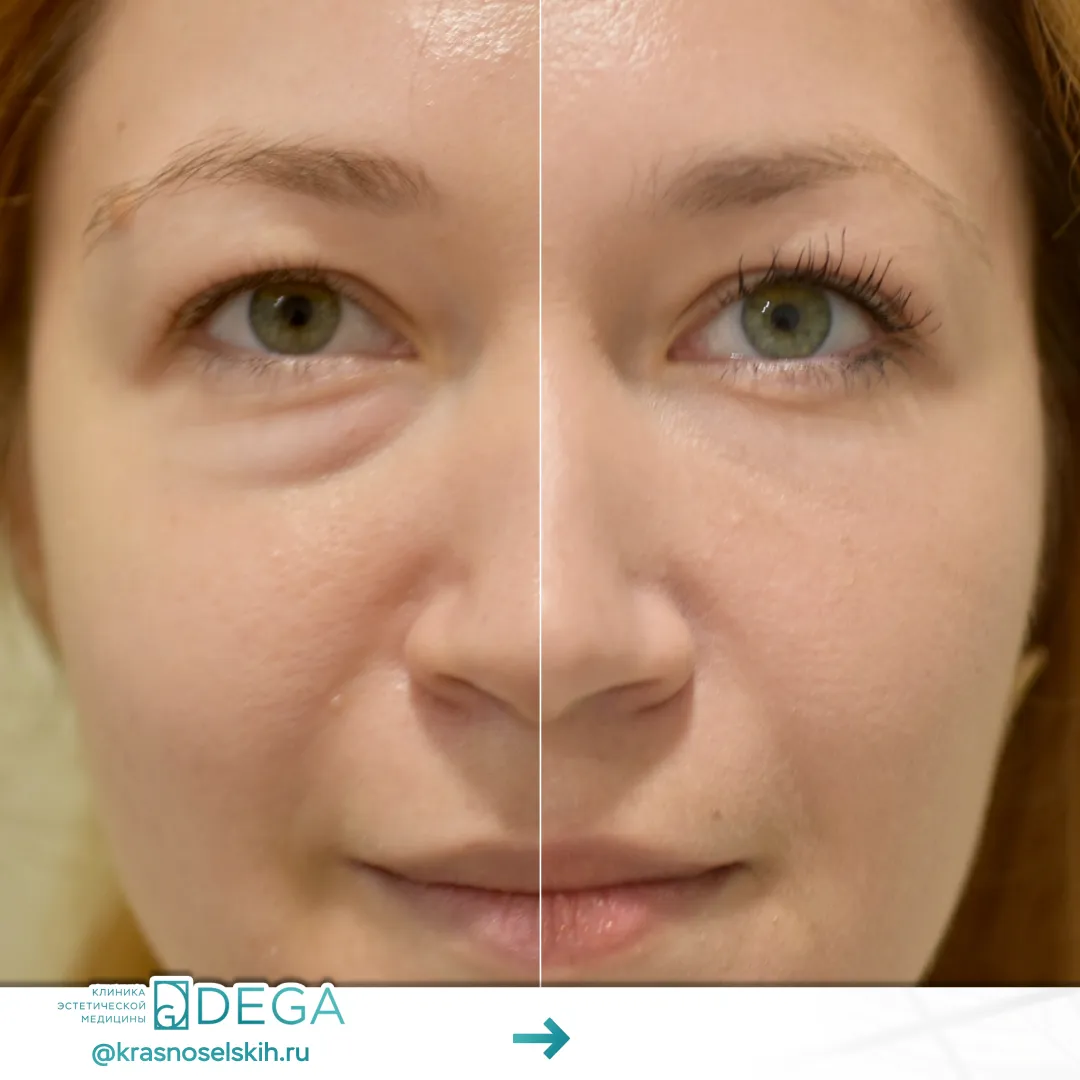 Красносельских МА - Эндоскопическая периорбитопластика №23