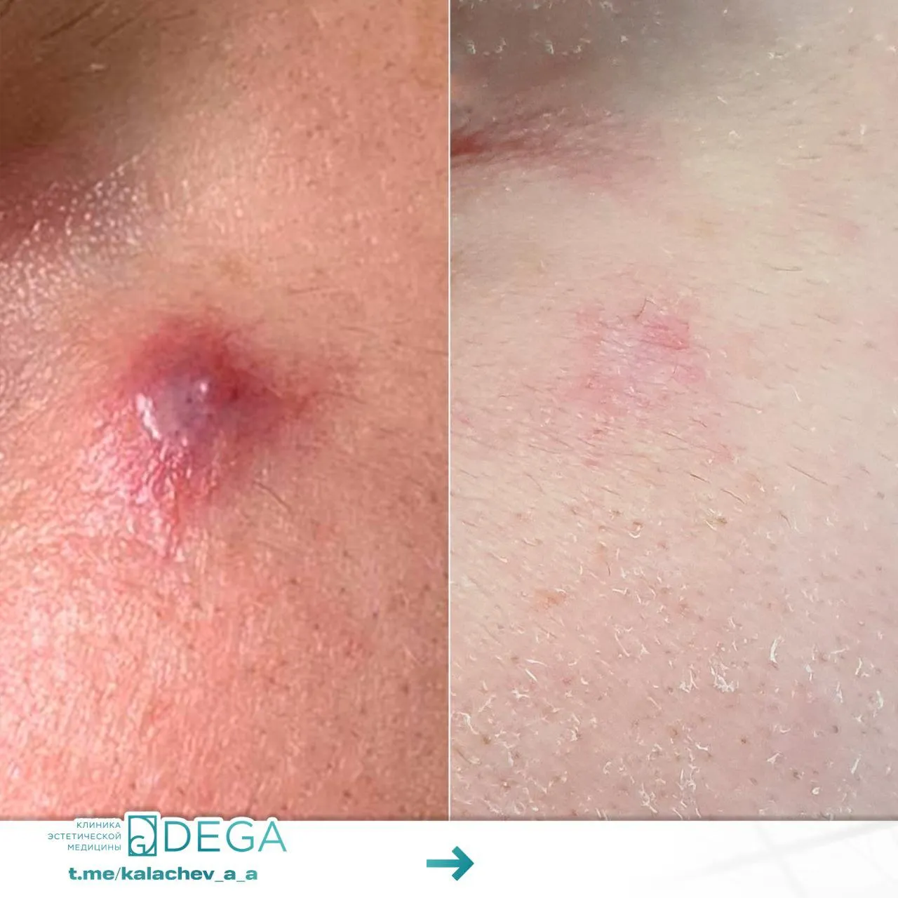 Калачев А.А. - №2 Эндовазальная лазерная коагуляция (ЭВЛК)