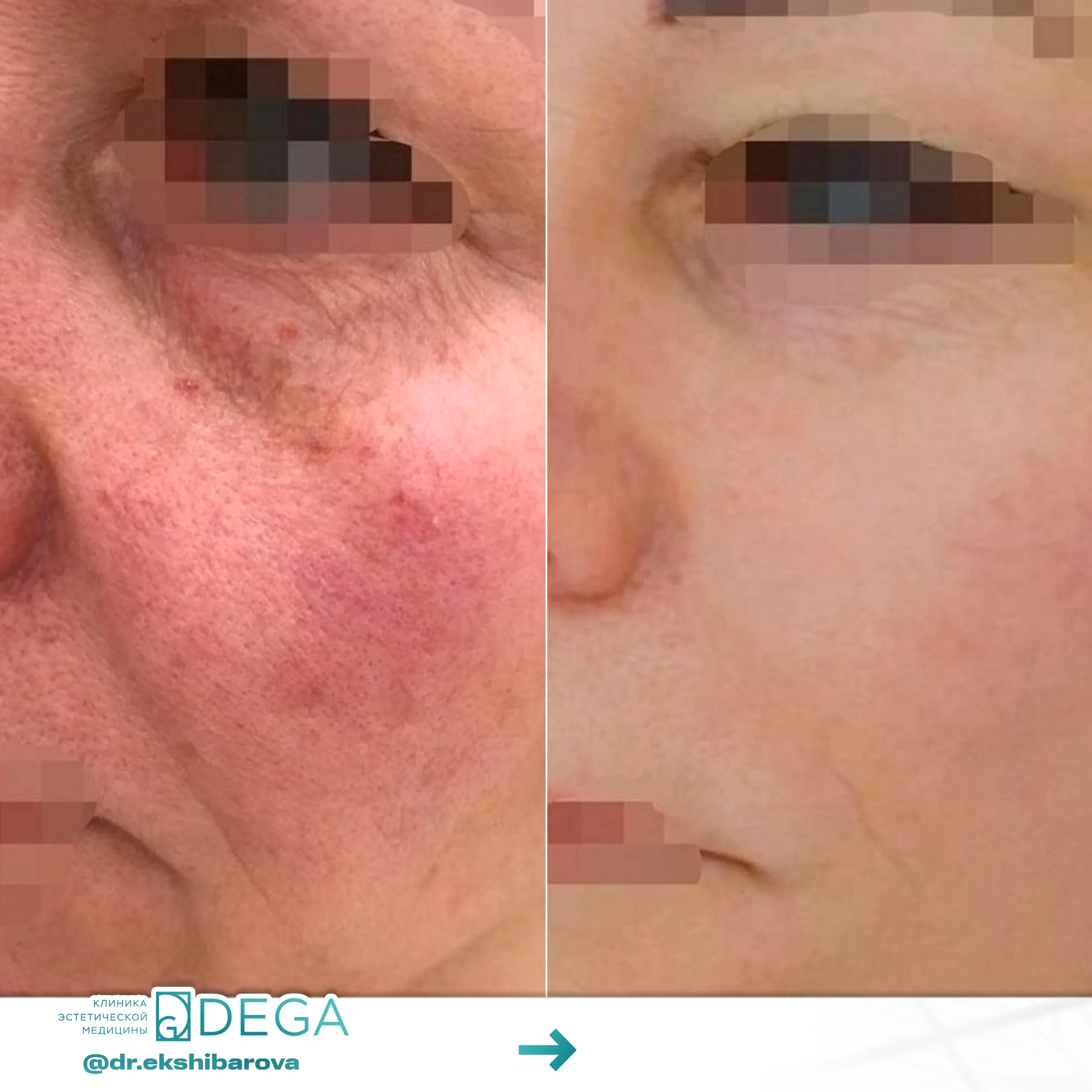 Екшибарова НИ - Инъекционная косметология, Аппаратная косметология №33