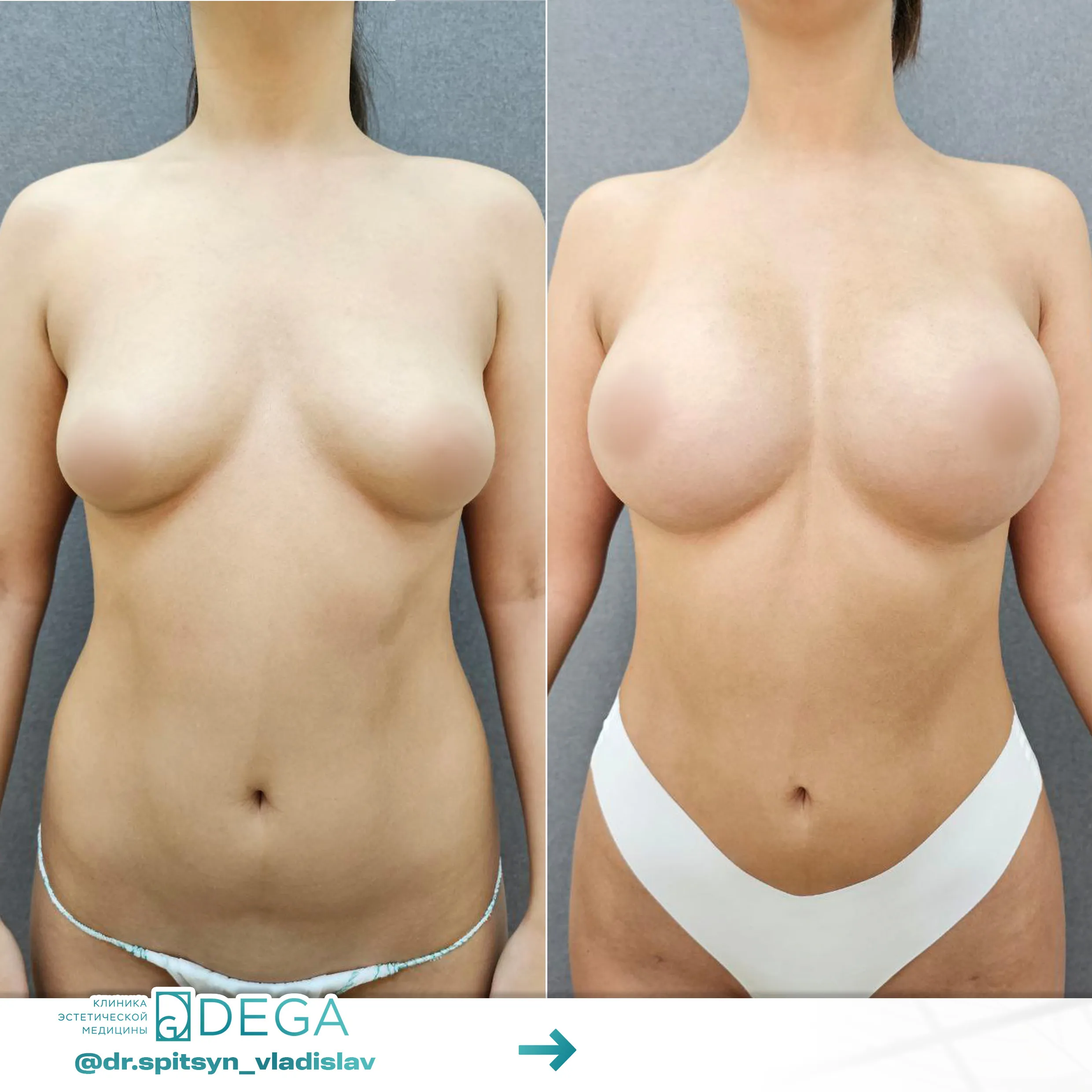 Спицын ВИ - Увеличение груди, Липофилинг тела №59