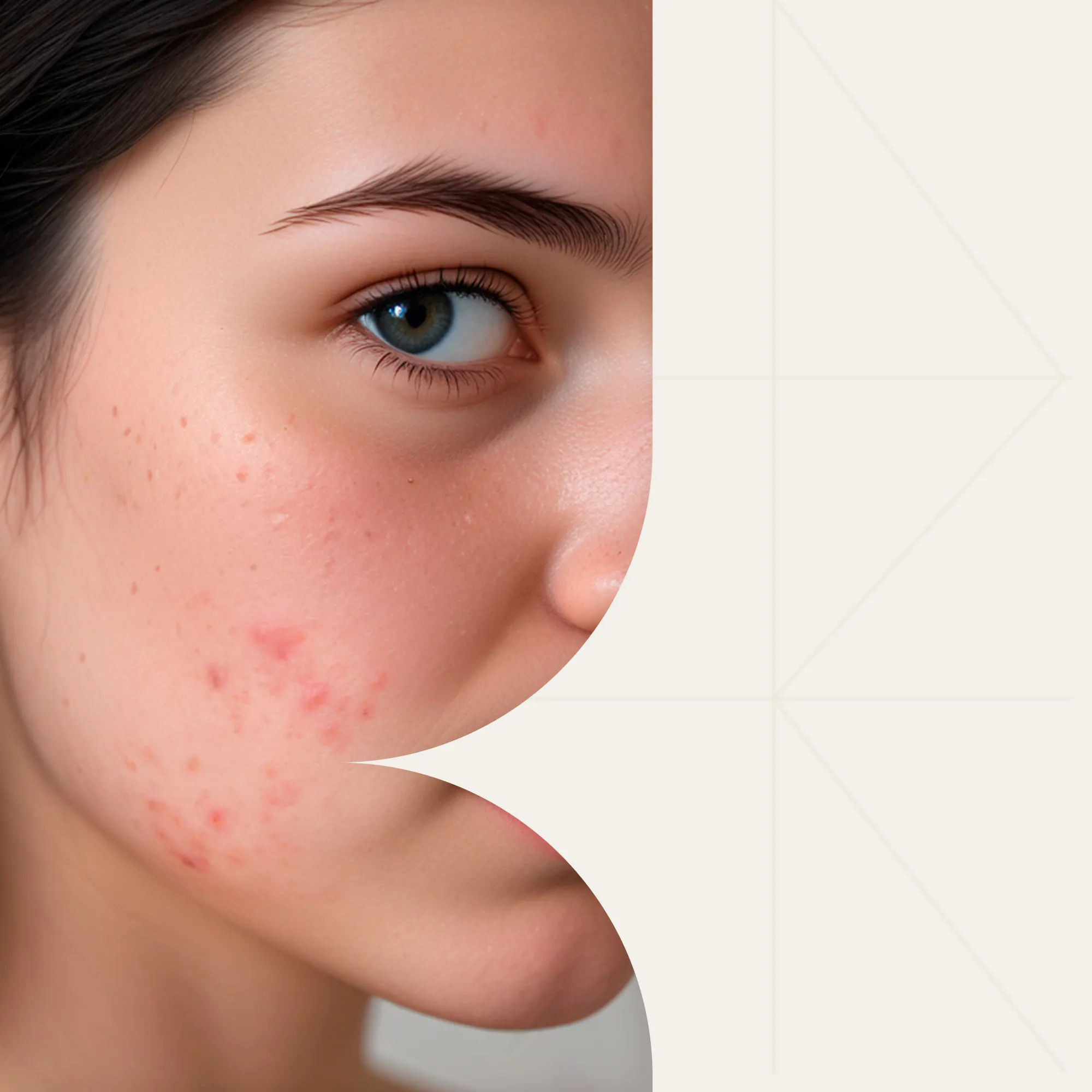 Топ способов коррекции постакне